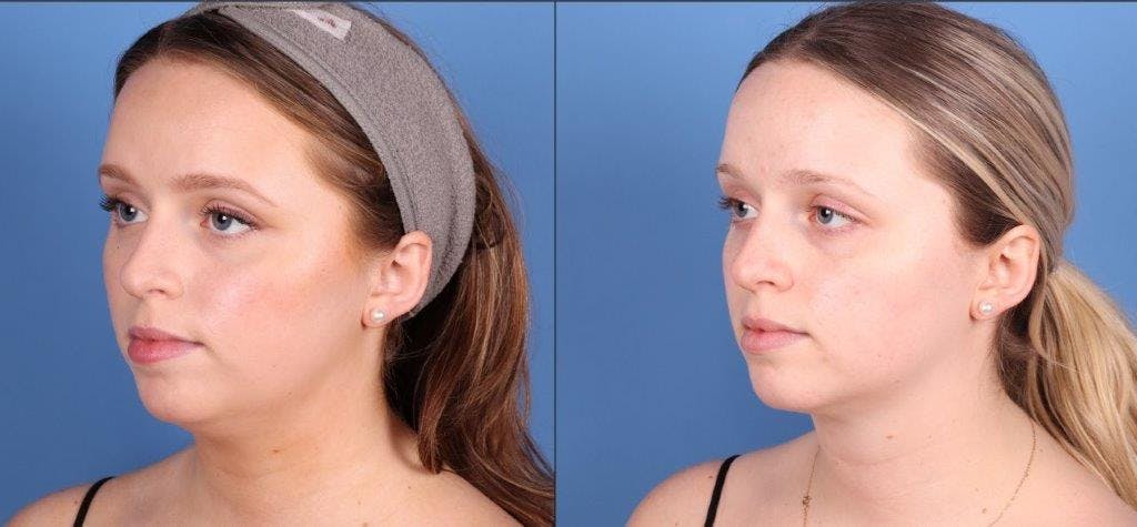 Face & Neck Before & After Gallery - Patient 320776 - Image 4