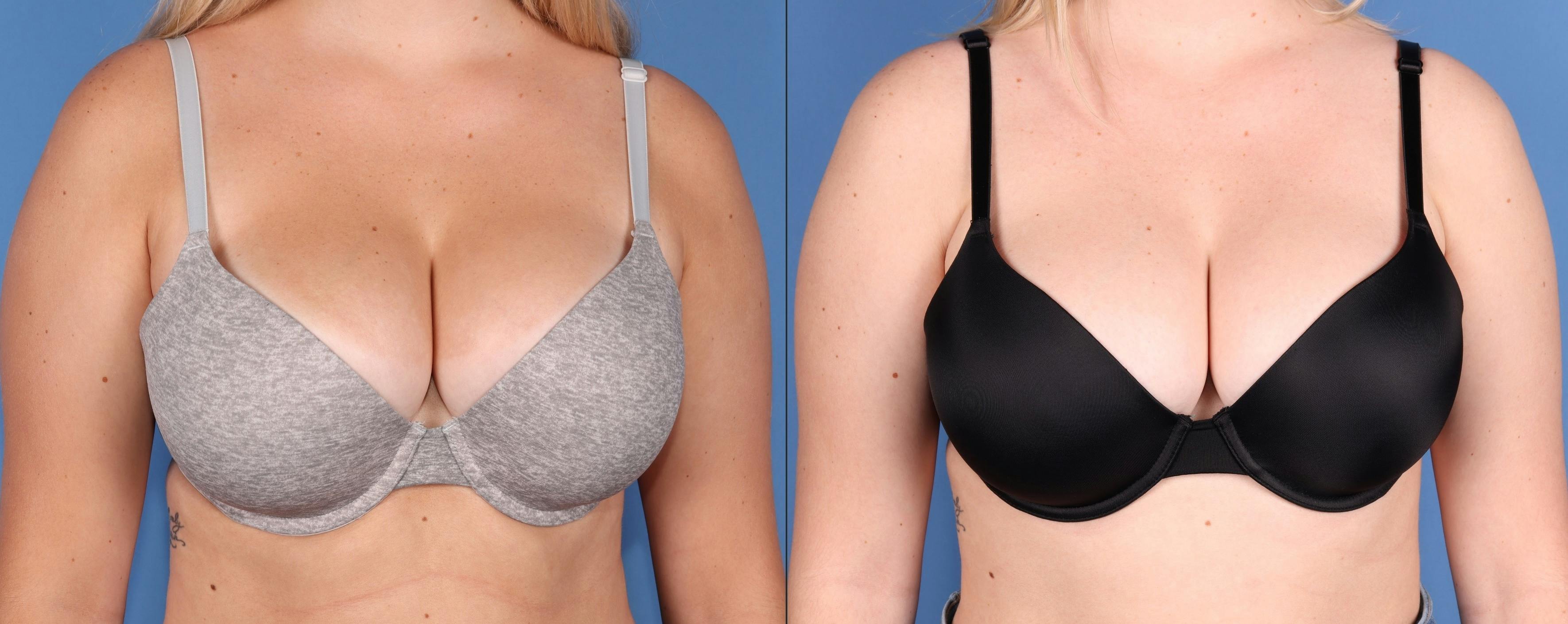 Chest Before & After Gallery - Patient 152771 - Image 1