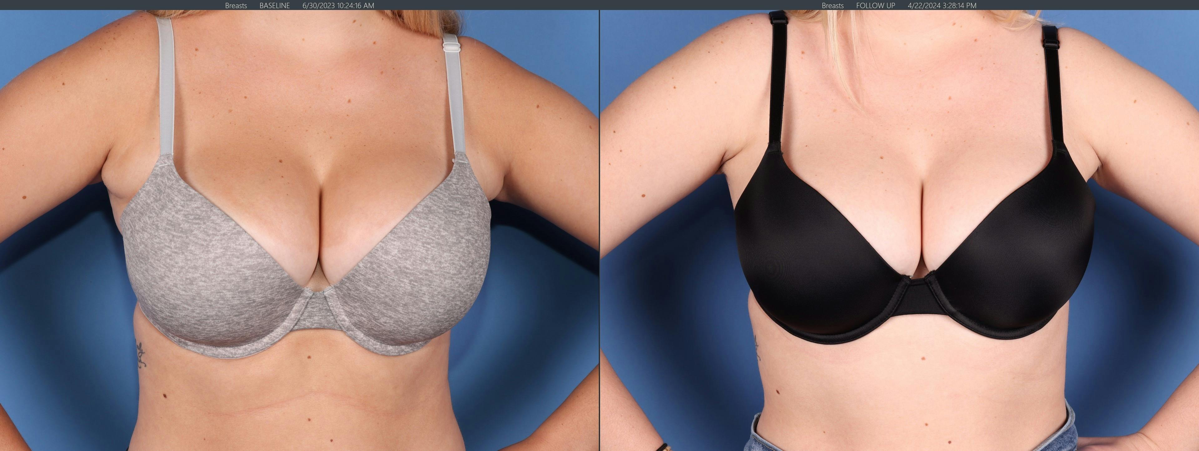 Chest Before & After Gallery - Patient 152771 - Image 2