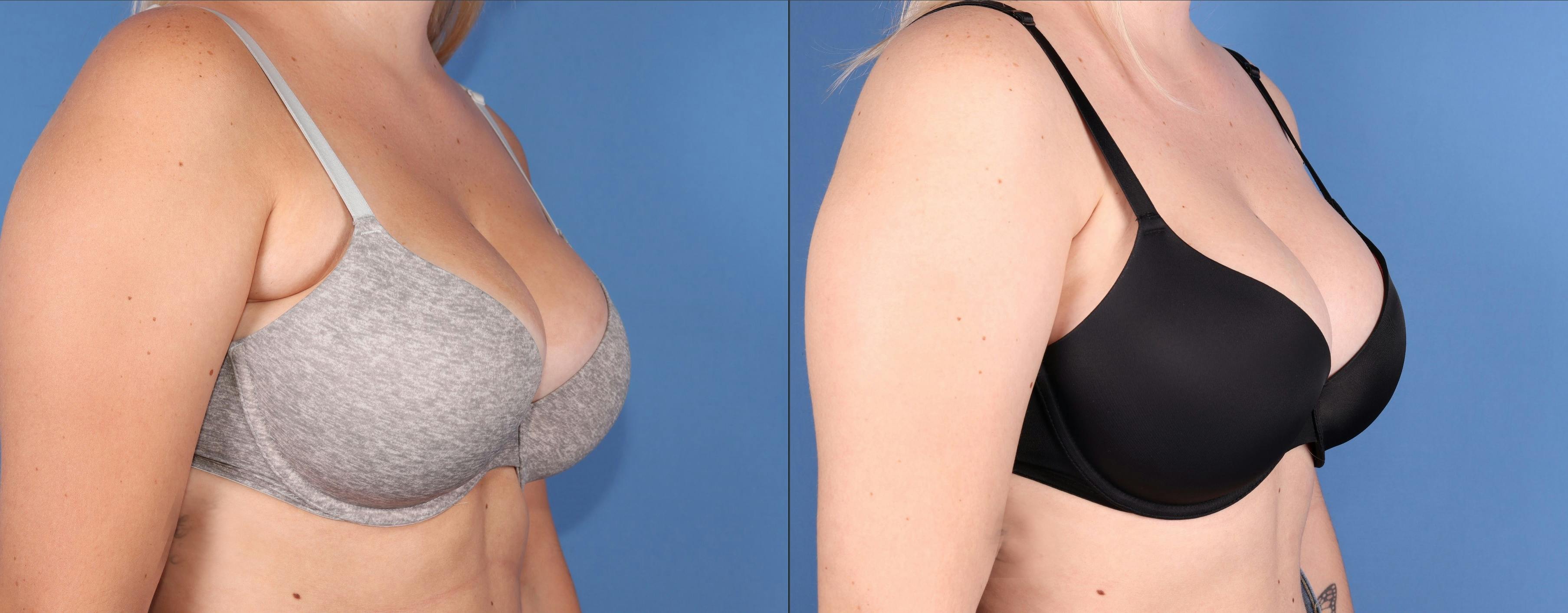 Chest Before & After Gallery - Patient 152771 - Image 3