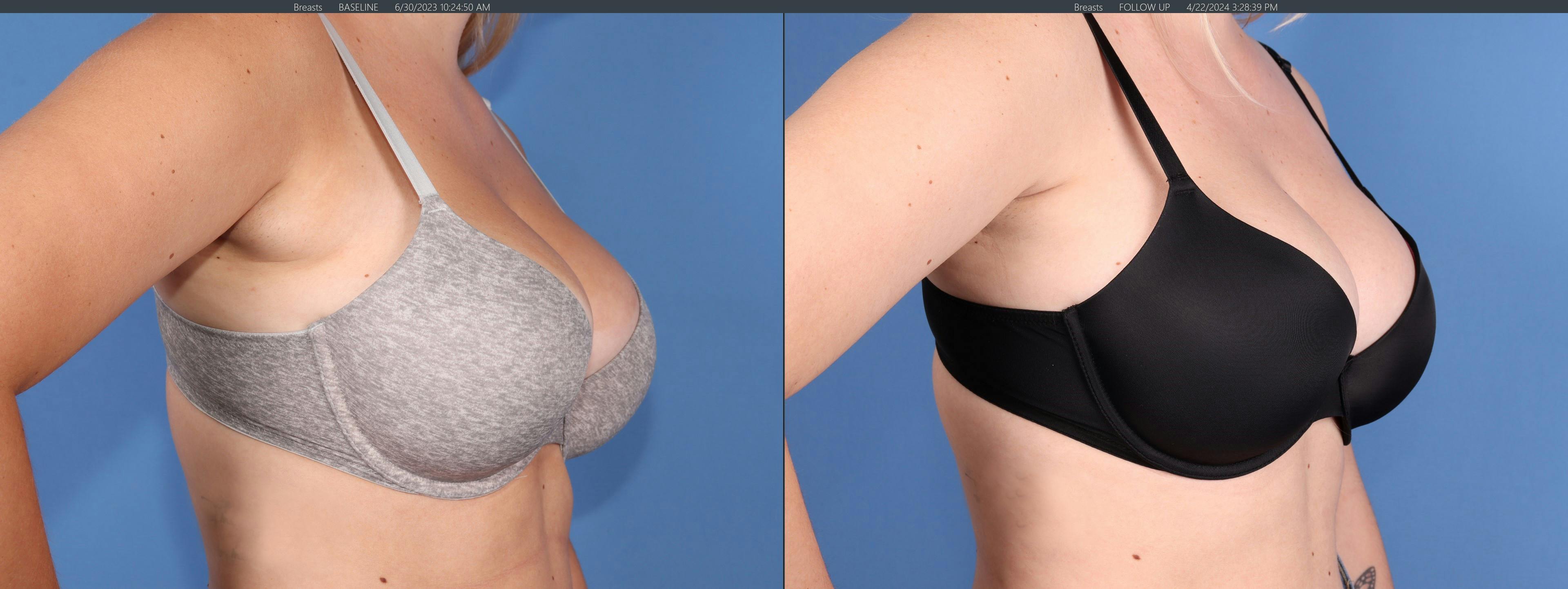 Chest Before & After Gallery - Patient 152771 - Image 4