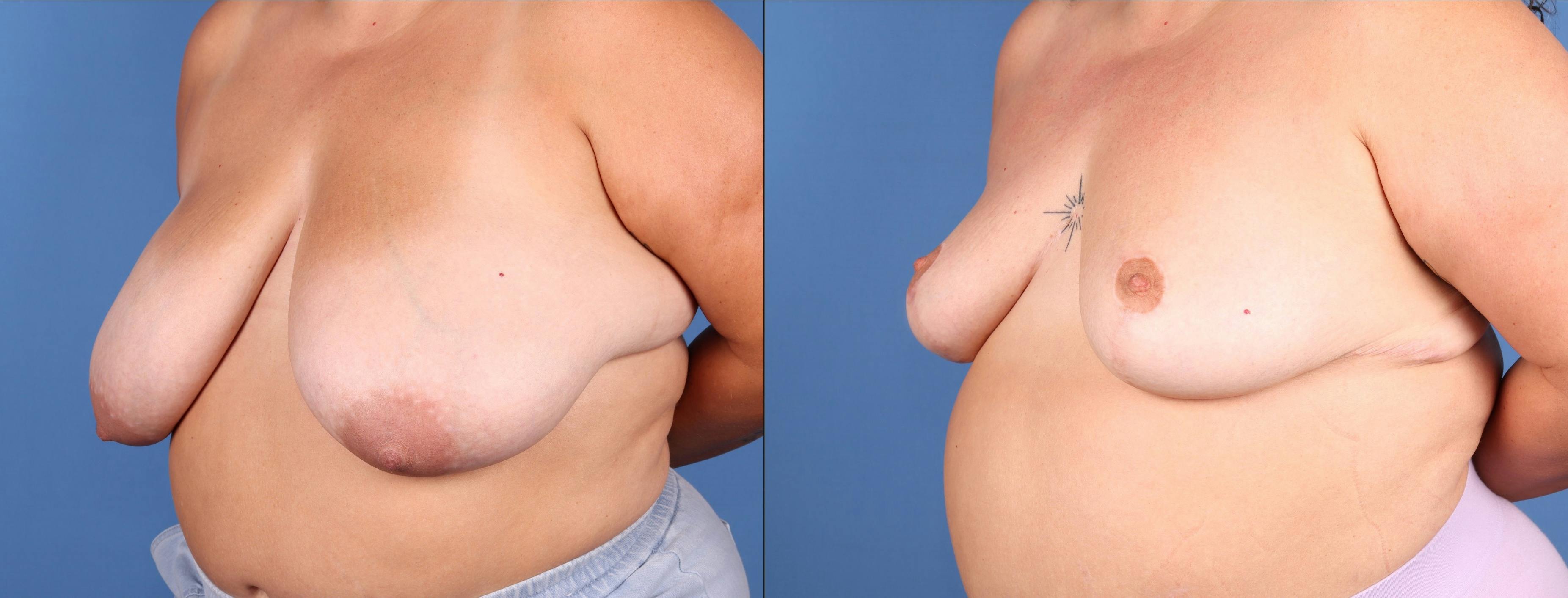 Breast Reduction Before & After Gallery - Patient 205043 - Image 2