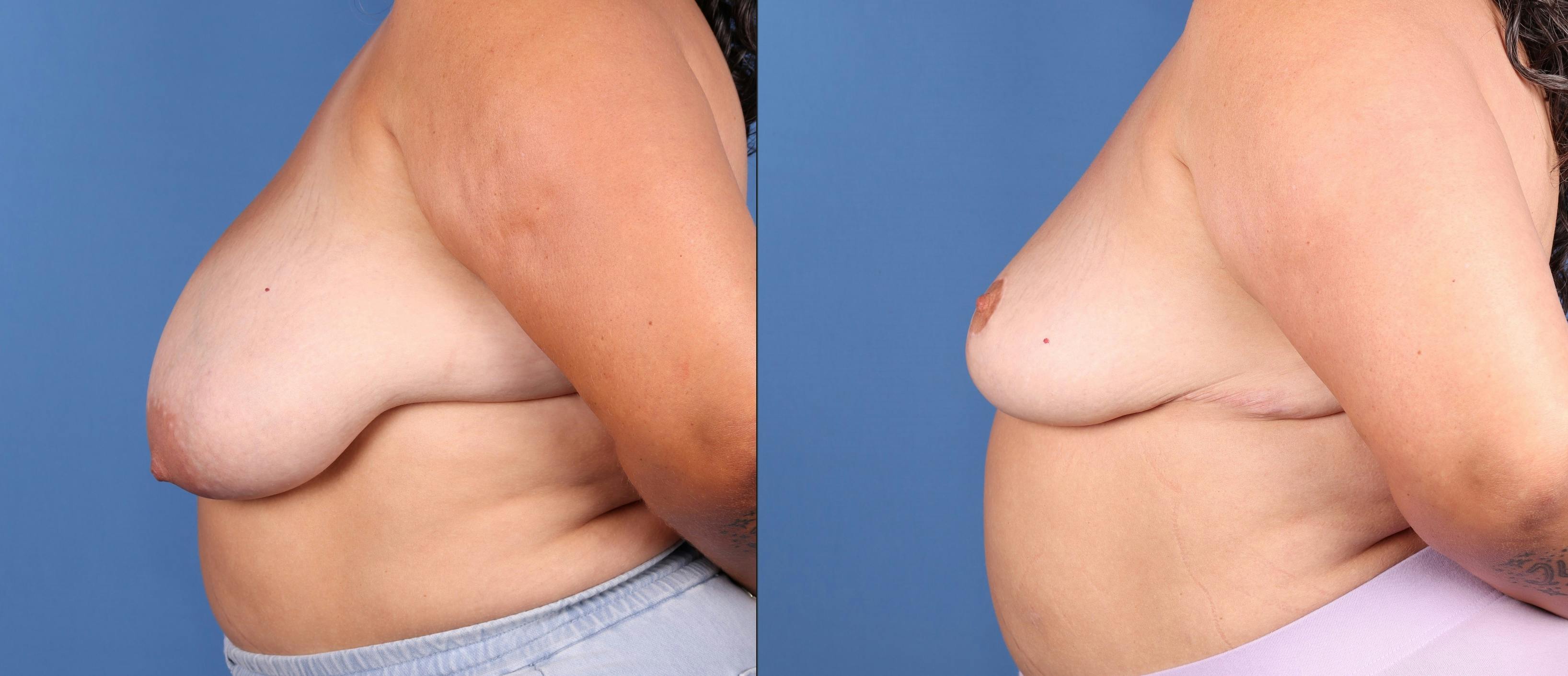 Breast Reduction Before & After Gallery - Patient 205043 - Image 3