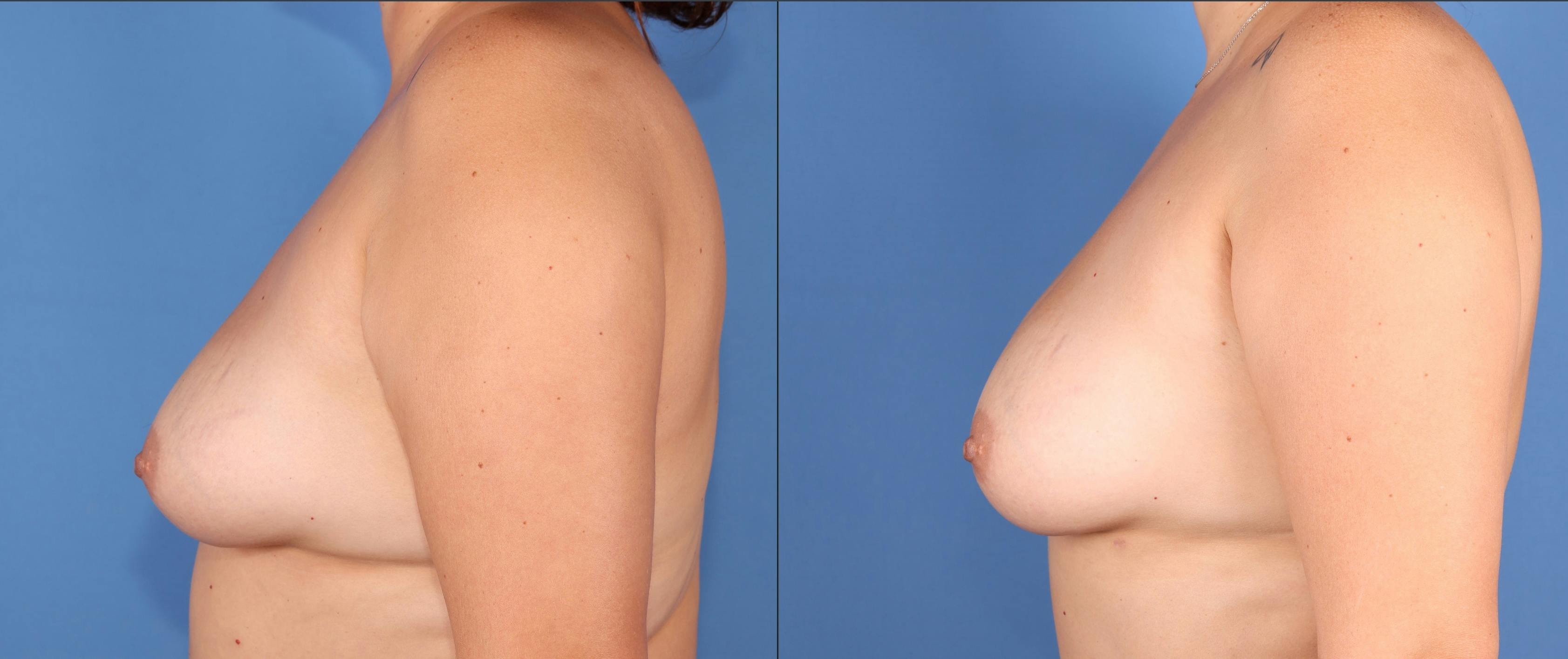 Fat Transfer Breast Augmentation Before & After Gallery - Patient 257490 - Image 3