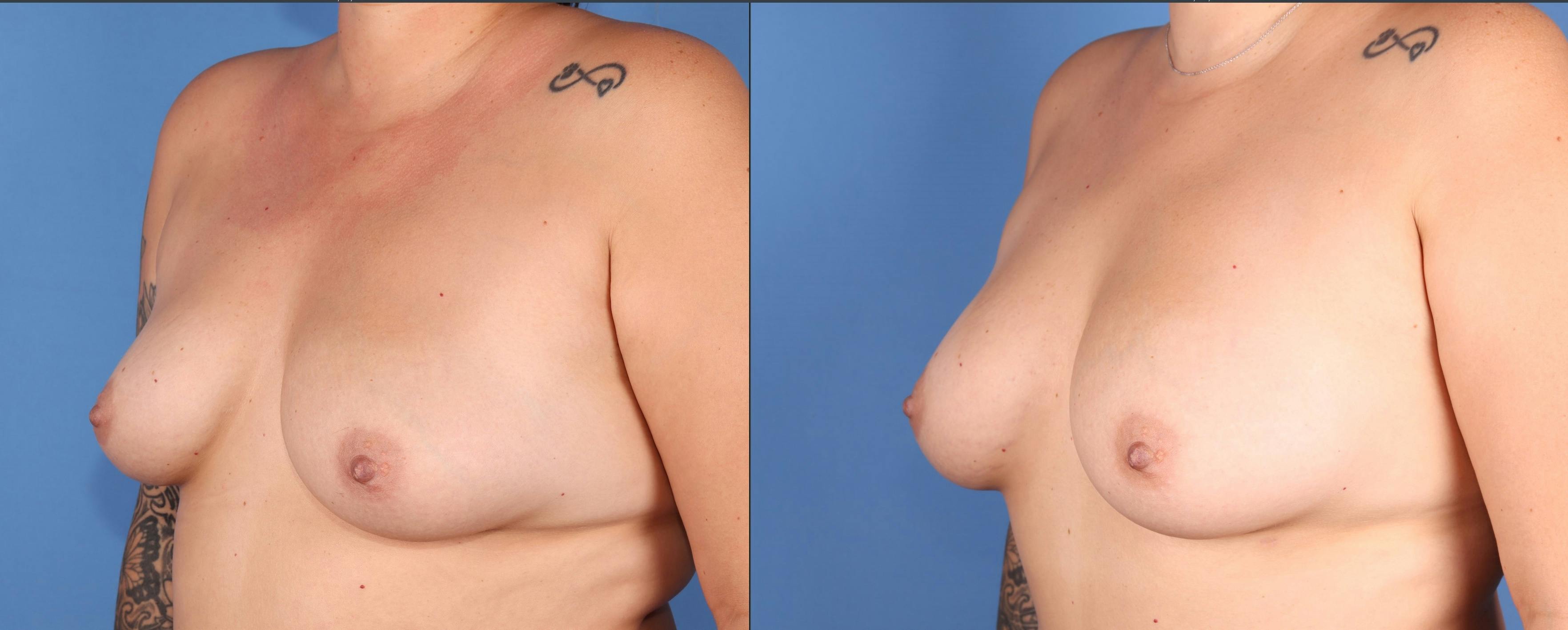Fat Transfer Breast Augmentation Before & After Gallery - Patient 257490 - Image 2