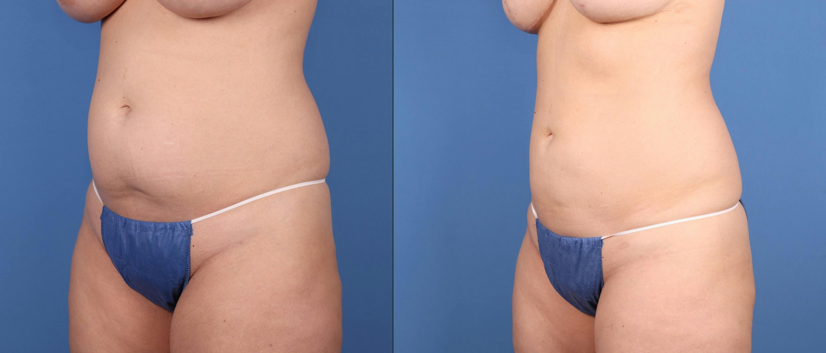 Abdomen Before & After Gallery - Patient 397865 - Image 1