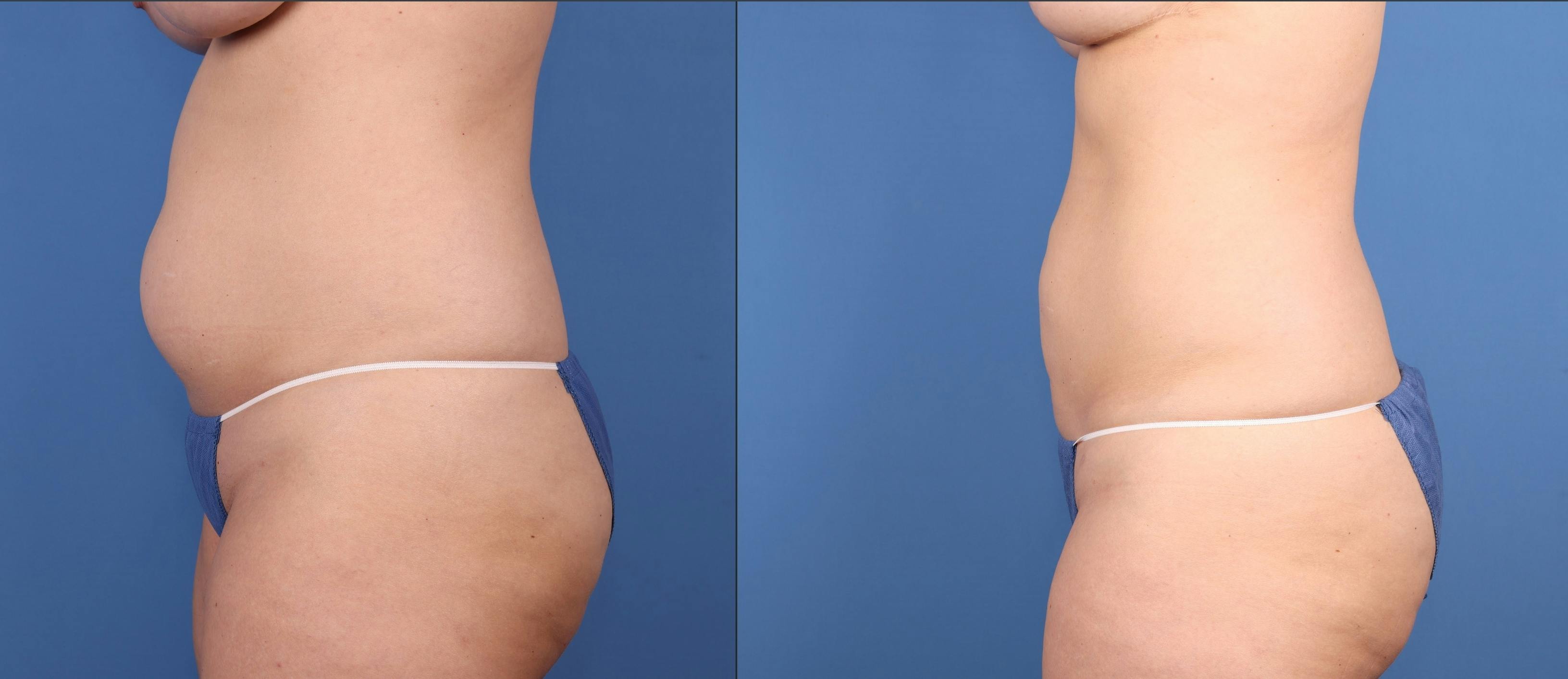 Abdomen Before & After Gallery - Patient 397865 - Image 2
