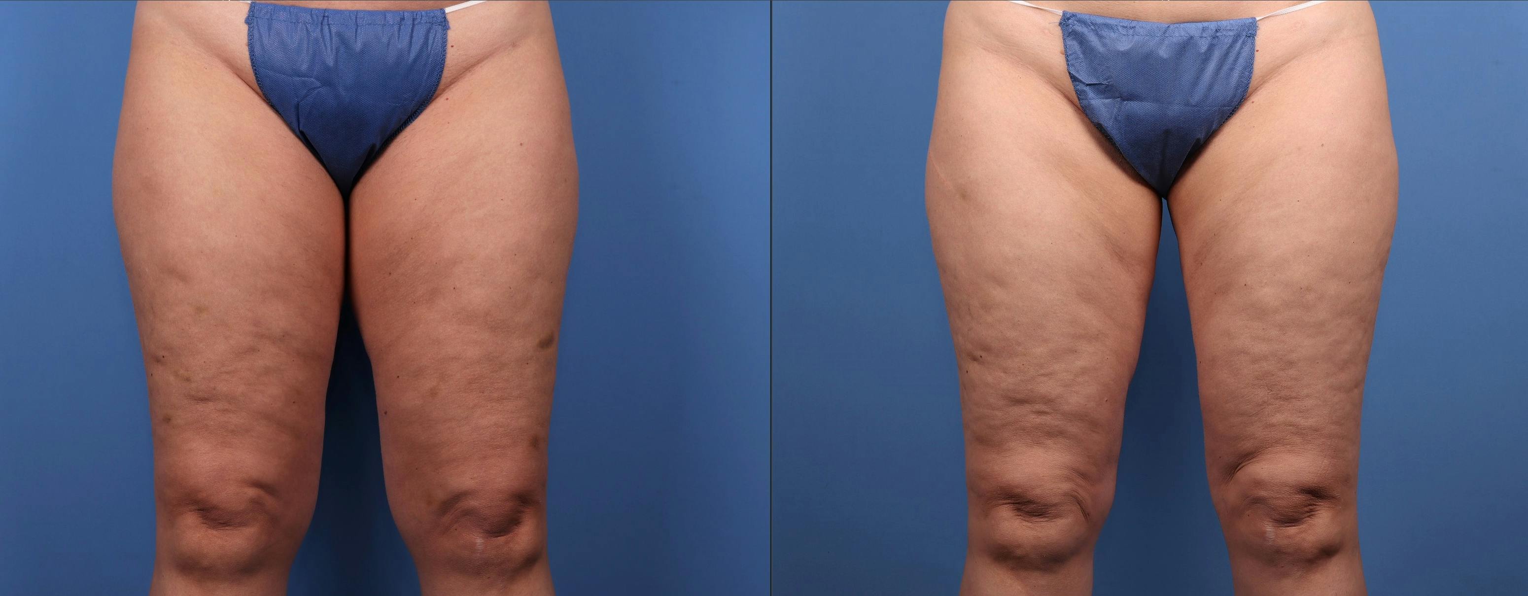 Thighs Before & After Gallery - Patient 401642 - Image 1