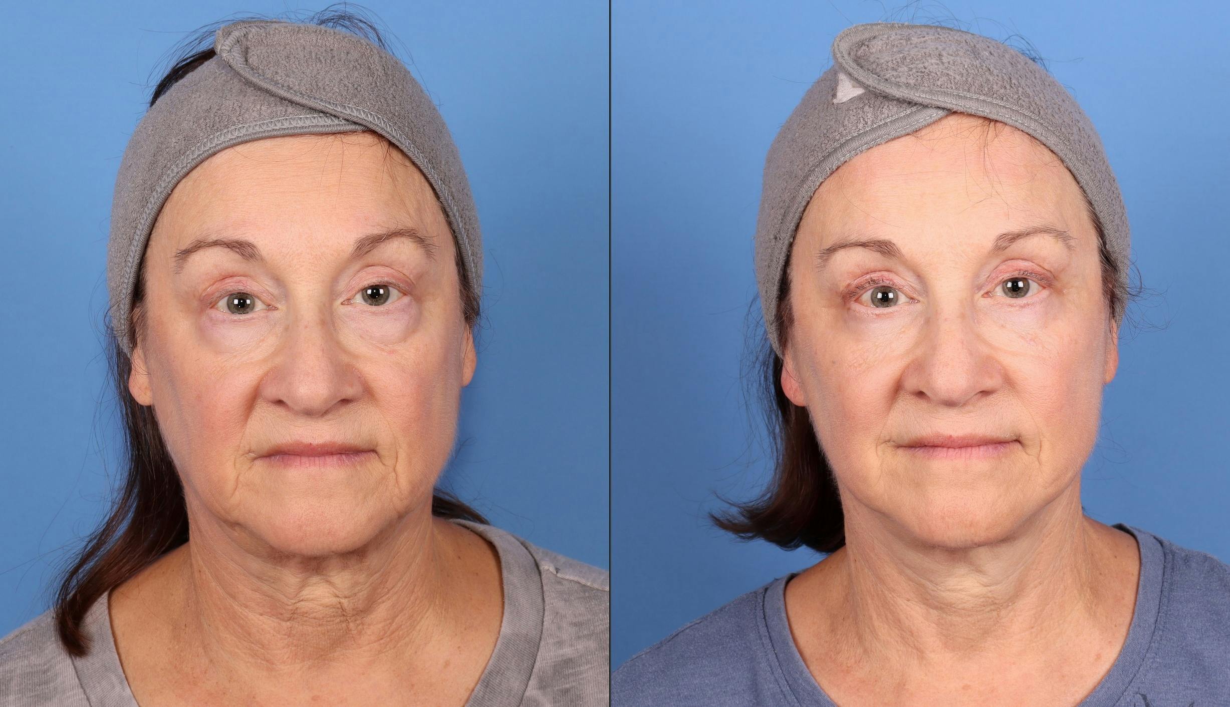 Face Lift Before & After Gallery - Patient 938292 - Image 1