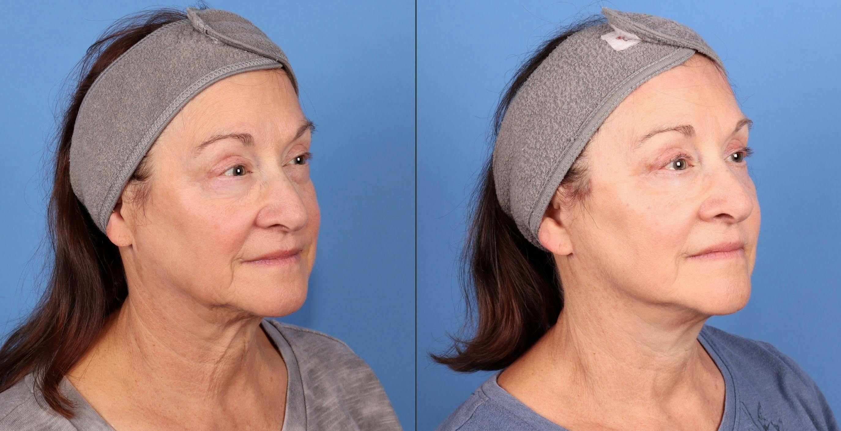 Eyelid Surgery (Blepharoplasty) Before & After Gallery - Patient 231975 - Image 2