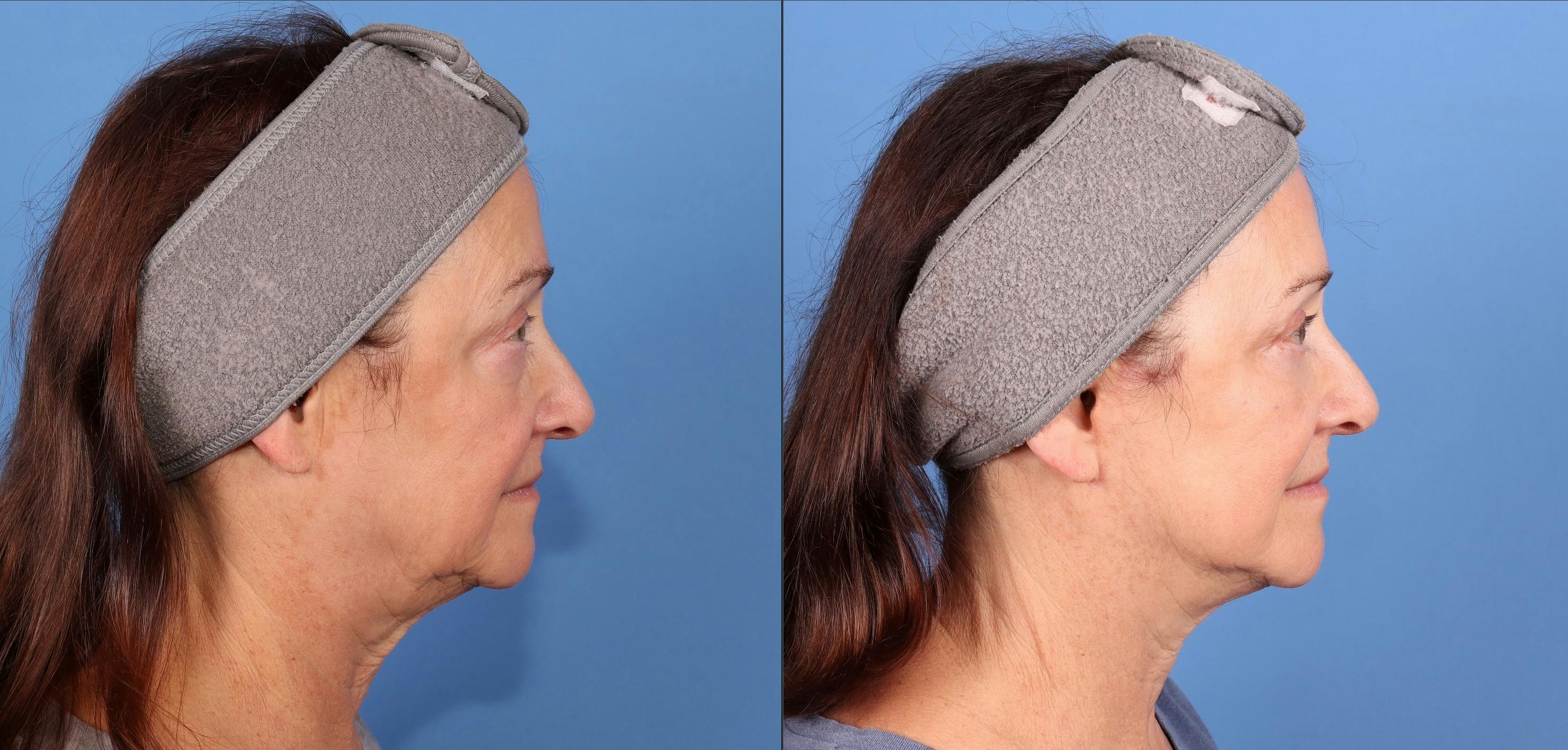 Face Lift Before & After Gallery - Patient 938292 - Image 3