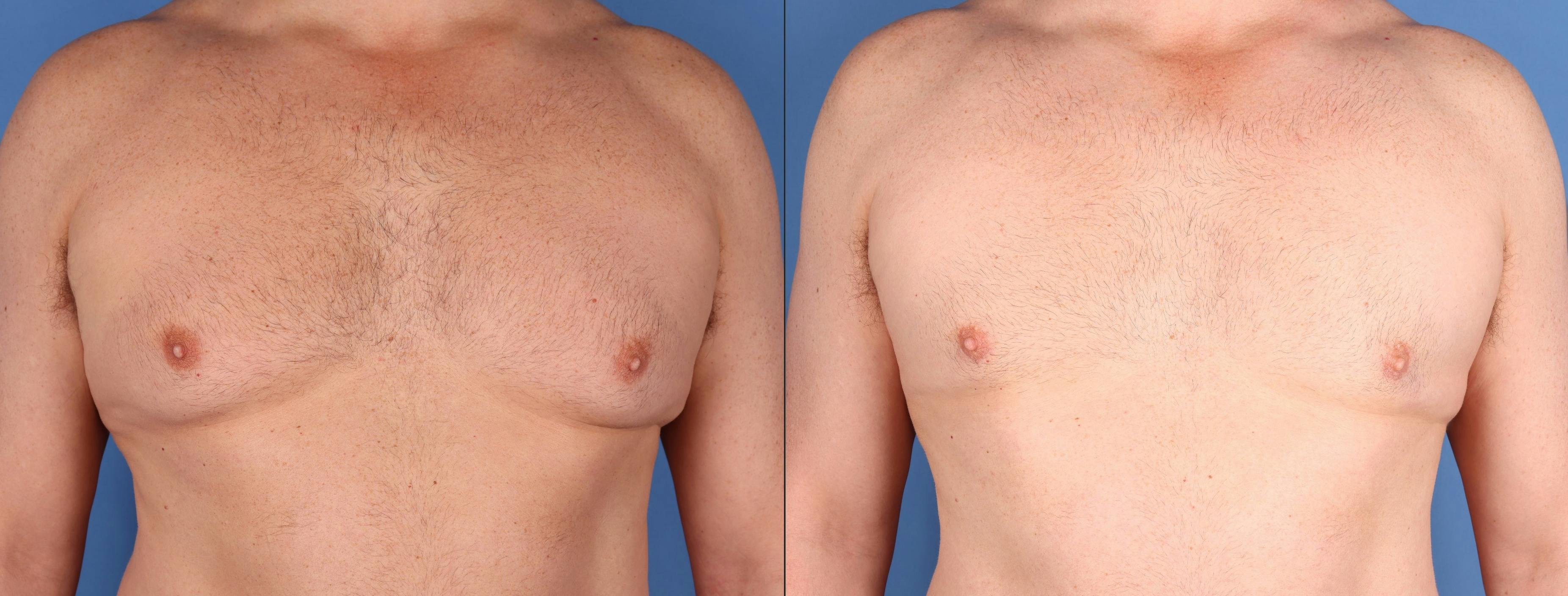 Male Breast Reduction Before & After Gallery - Patient 410274 - Image 1
