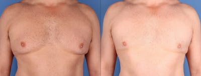 Male Breast Reduction Before & After Gallery - Patient 410274 - Image 1