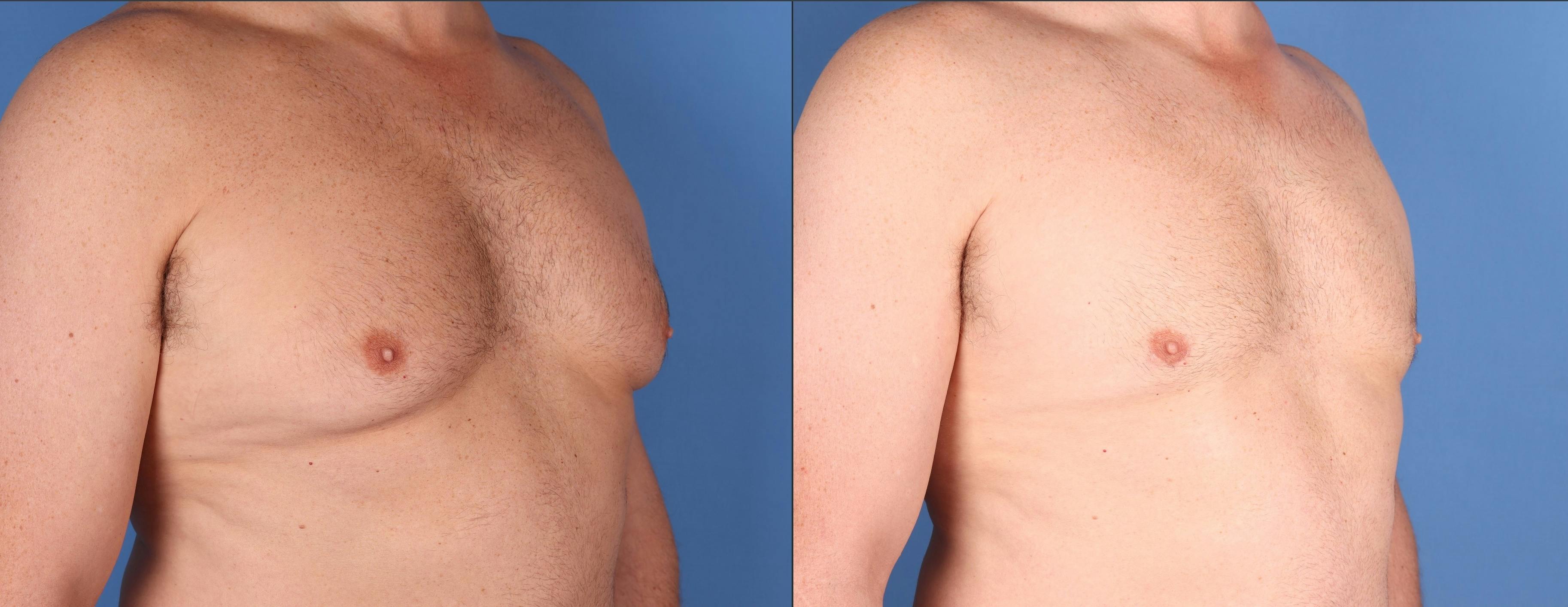 Male Breast Reduction Before & After Gallery - Patient 410274 - Image 2