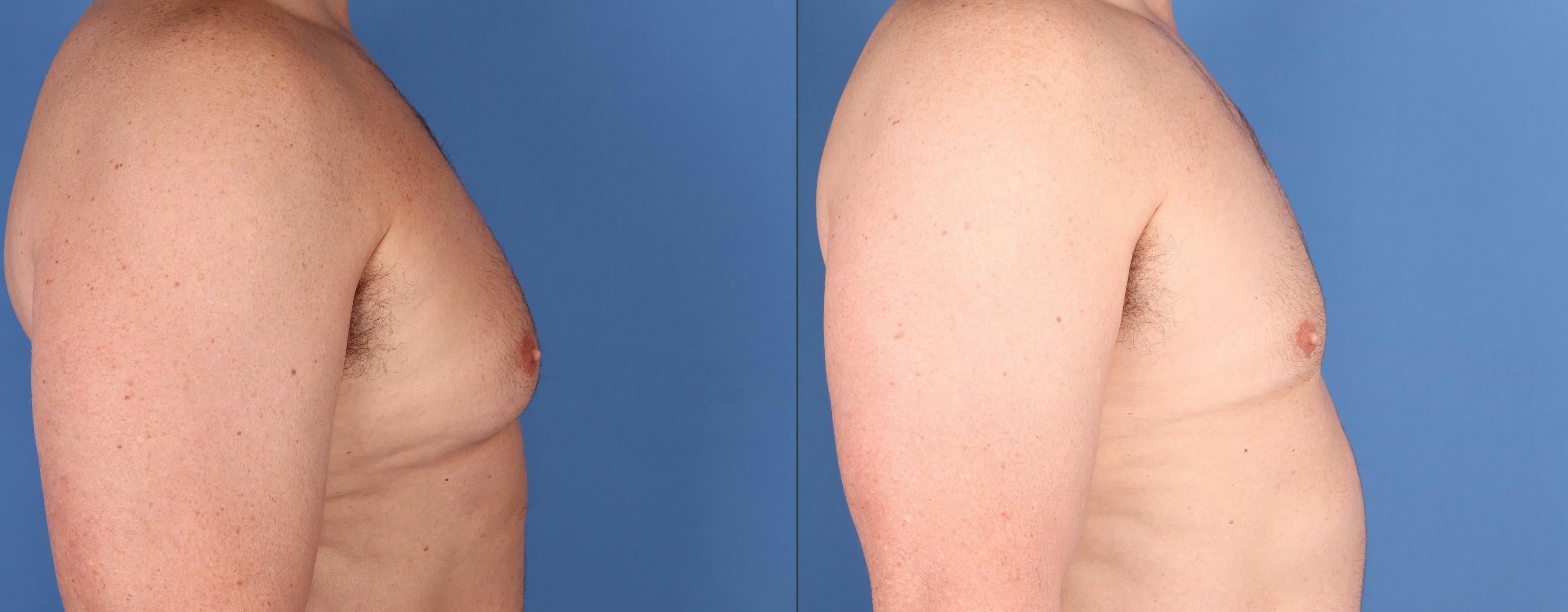 Male Breast Reduction Before & After Gallery - Patient 410274 - Image 3