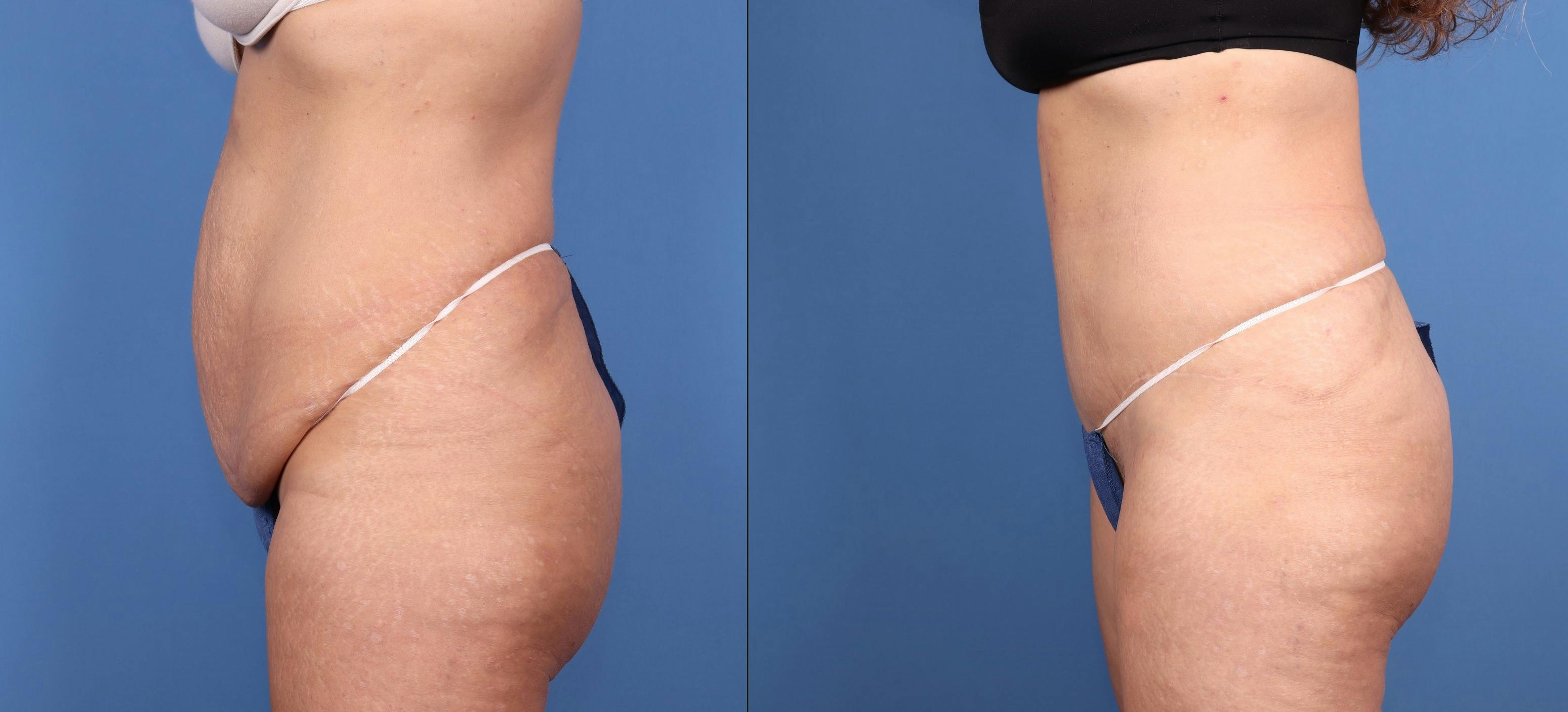 Tummy Tuck Before & After Gallery - Patient 140983 - Image 3