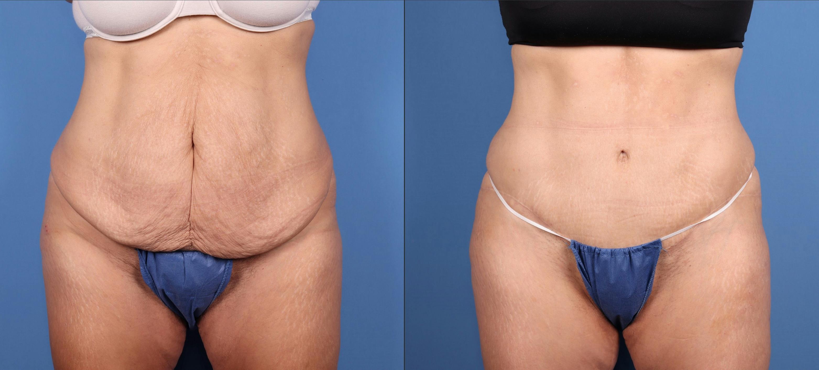 Tummy Tuck Before & After Gallery - Patient 140983 - Image 1