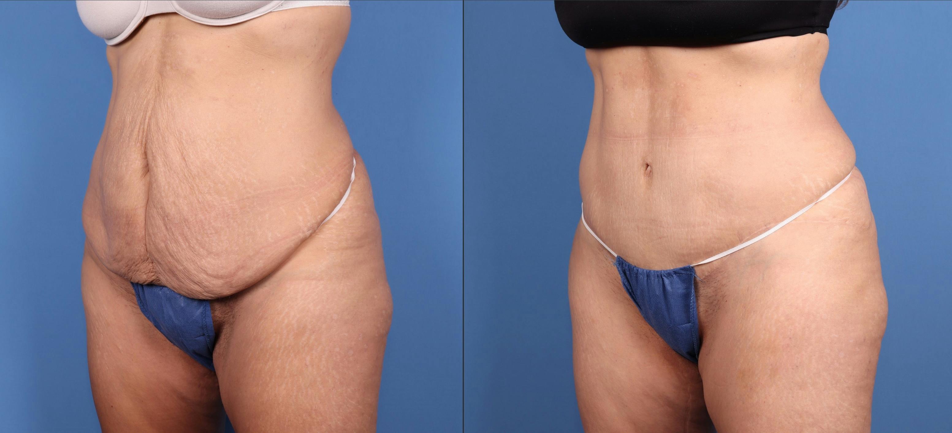 Tummy Tuck Before & After Gallery - Patient 140983 - Image 2