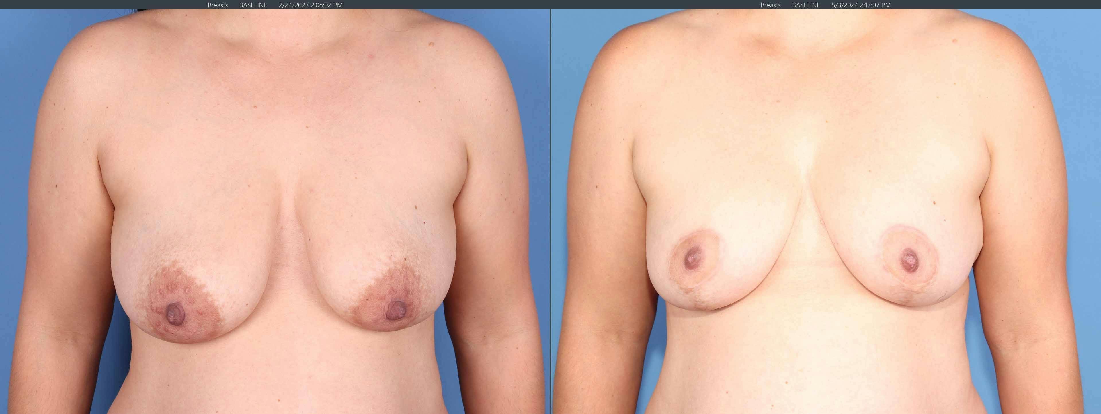 Breast Lift Before & After Gallery - Patient 308691 - Image 1