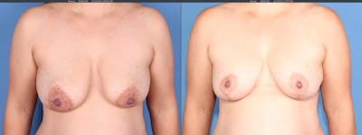 Breast Lift Before & After Gallery - Patient 308691 - Image 1