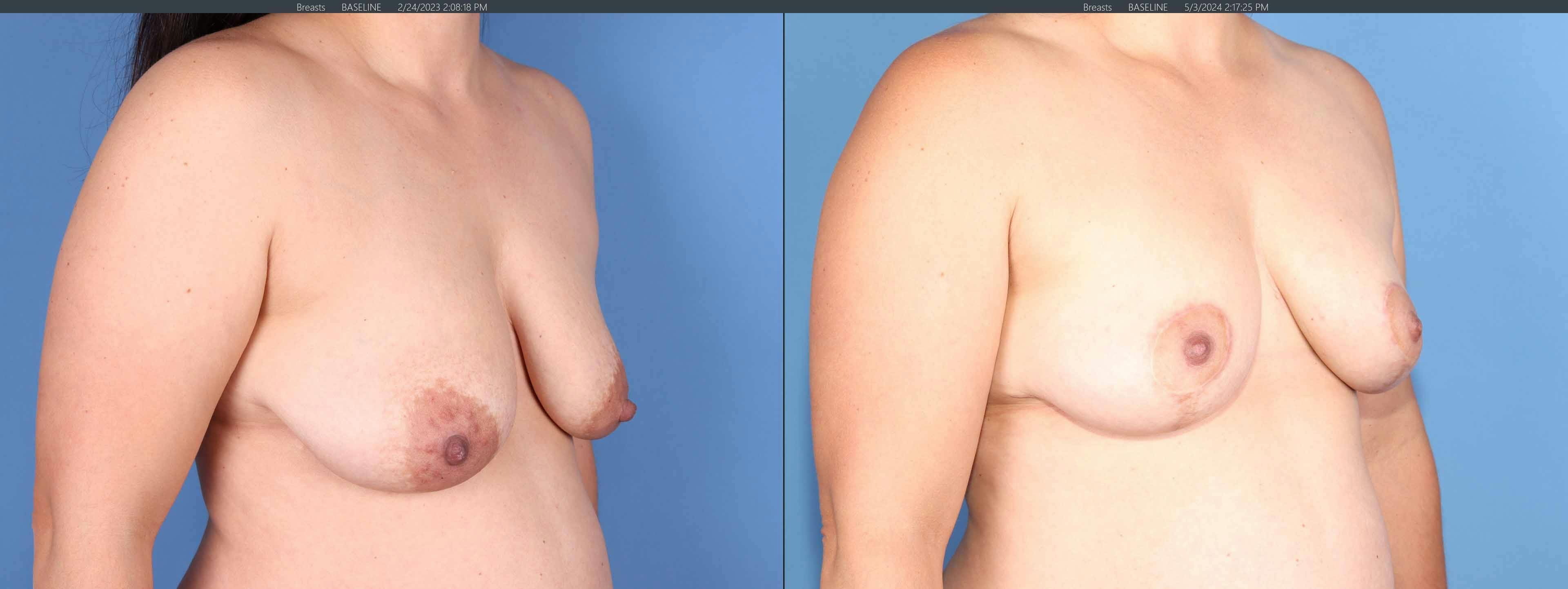 Breast Lift Before & After Gallery - Patient 308691 - Image 2