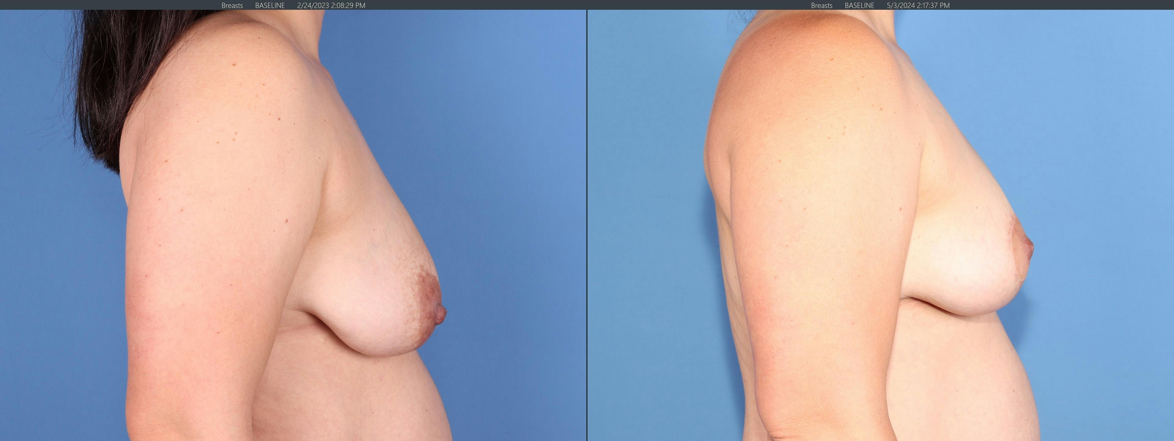 Breast Lift Before & After Gallery - Patient 308691 - Image 3