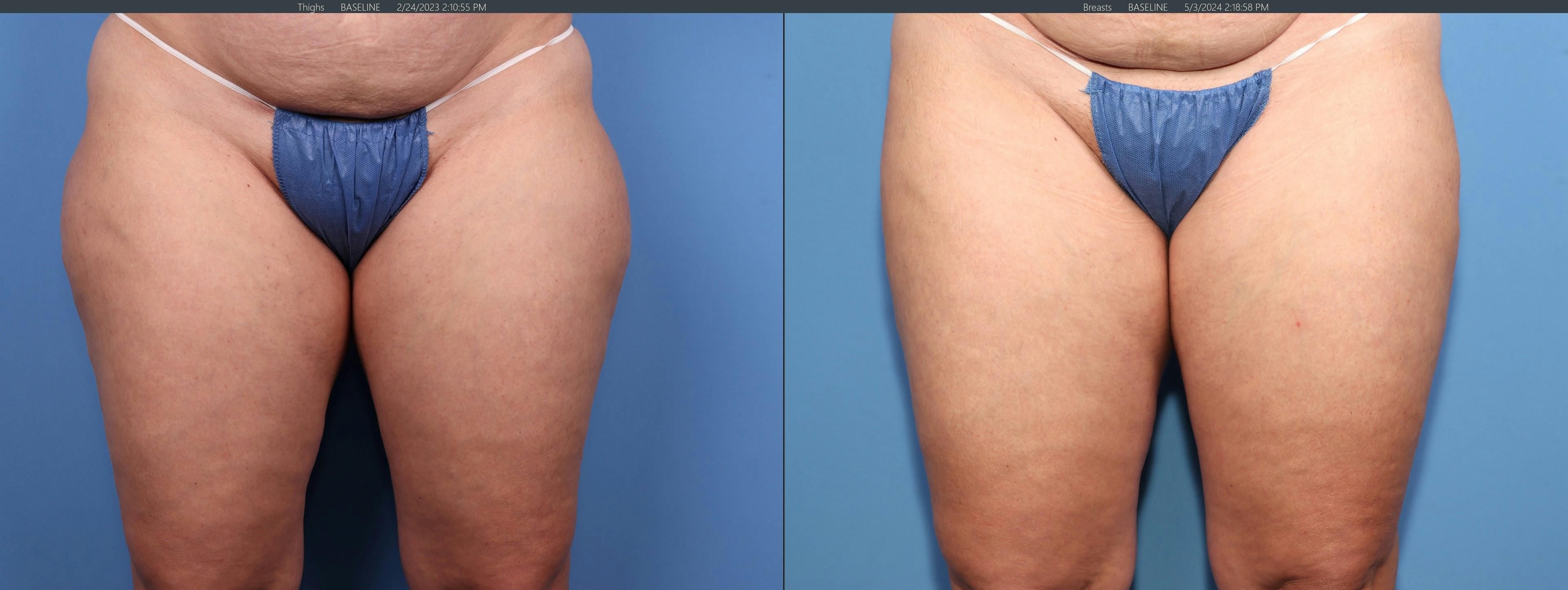 Thighs Before & After Gallery - Patient 336597 - Image 1