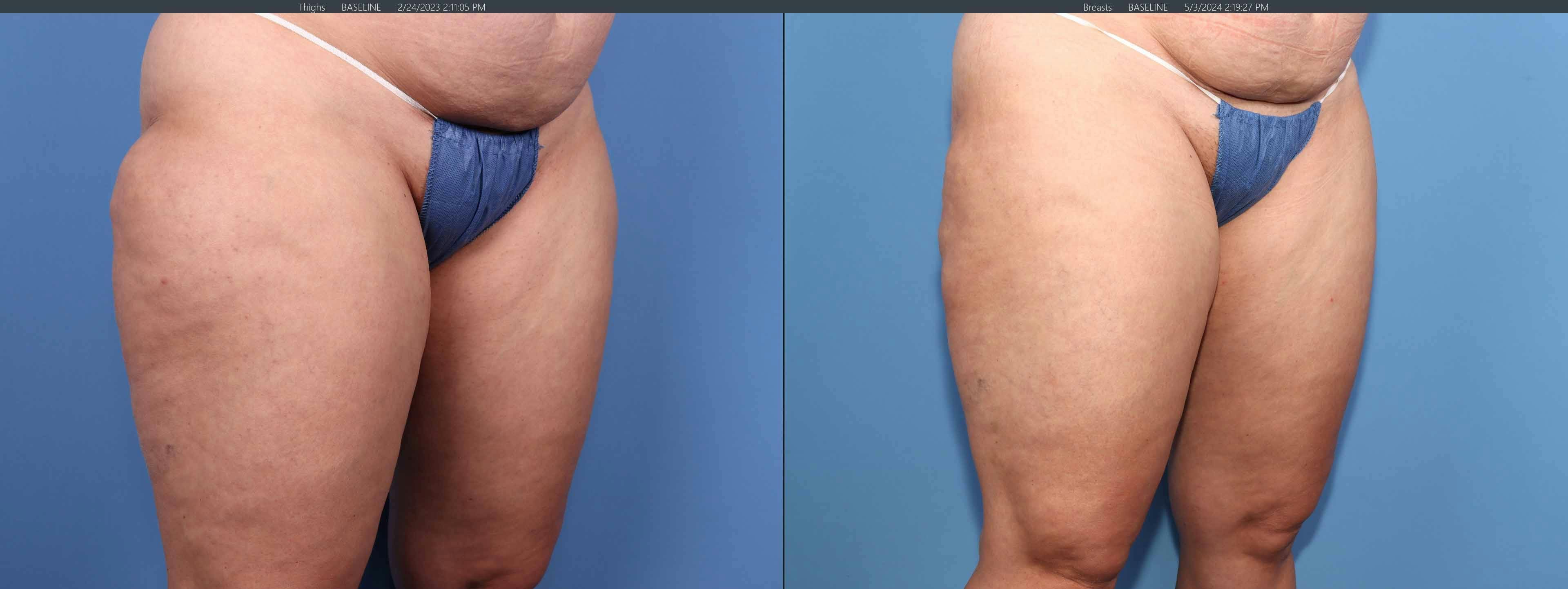 Thighs Before & After Gallery - Patient 336597 - Image 2