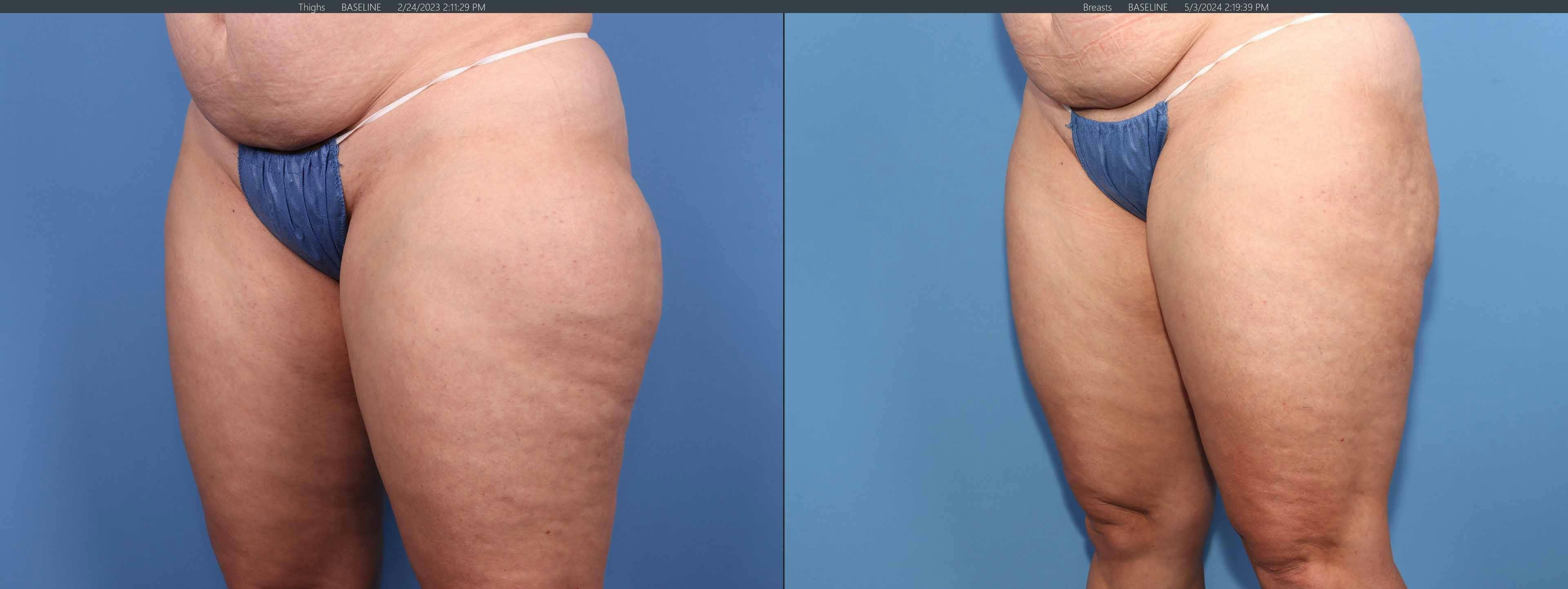 Thighs Before & After Gallery - Patient 336597 - Image 3
