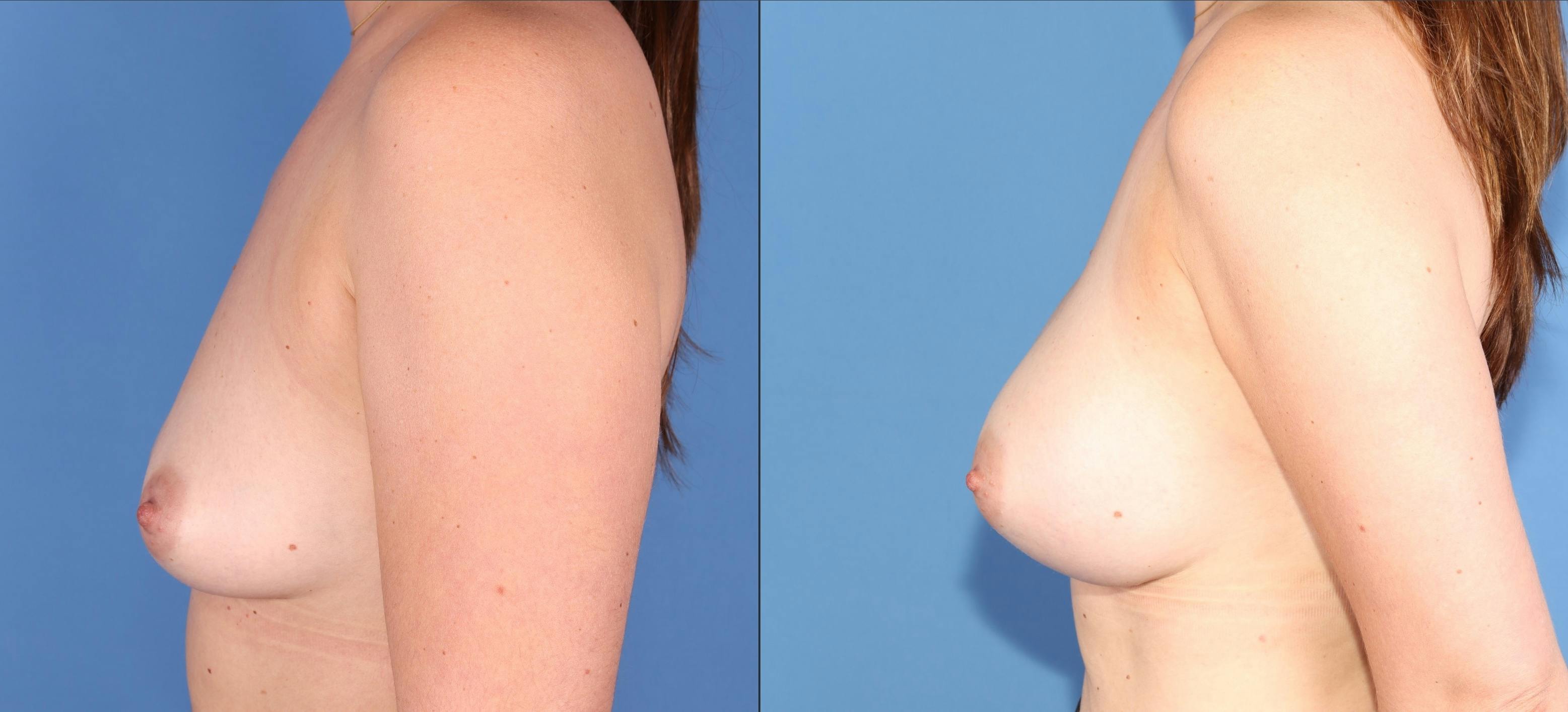 Breast Augmentation Before & After Gallery - Patient 220860 - Image 5