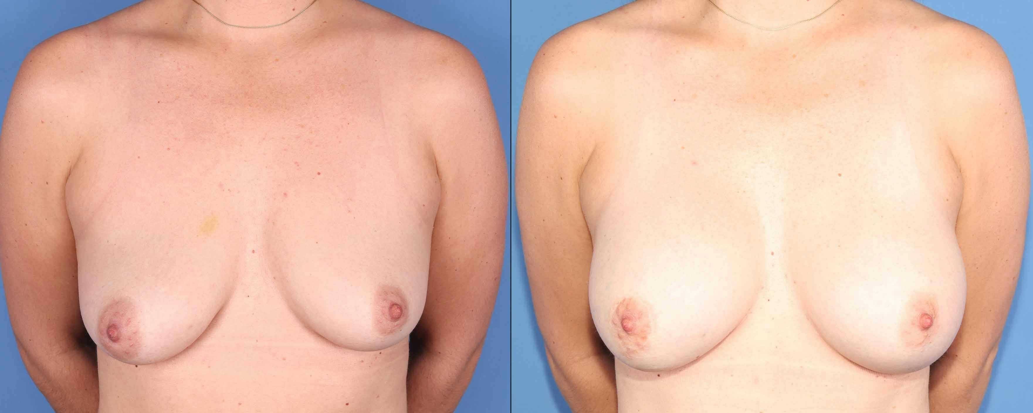 Breast Lift Before & After Gallery - Patient 354343 - Image 1