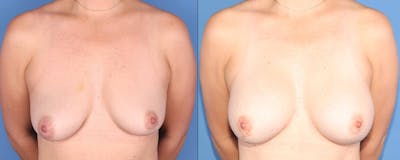 Breast Lift Before & After Gallery - Patient 354343 - Image 1