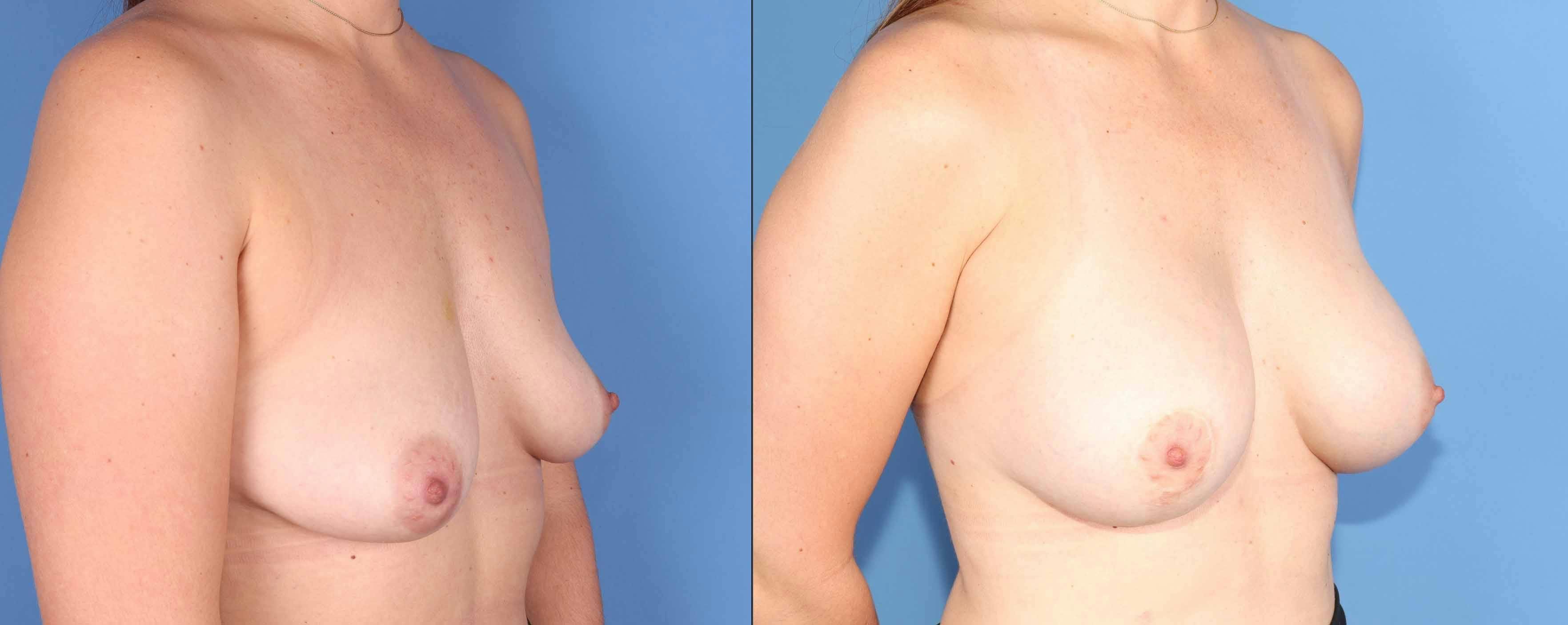 Breast Augmentation Before & After Gallery - Patient 220860 - Image 2