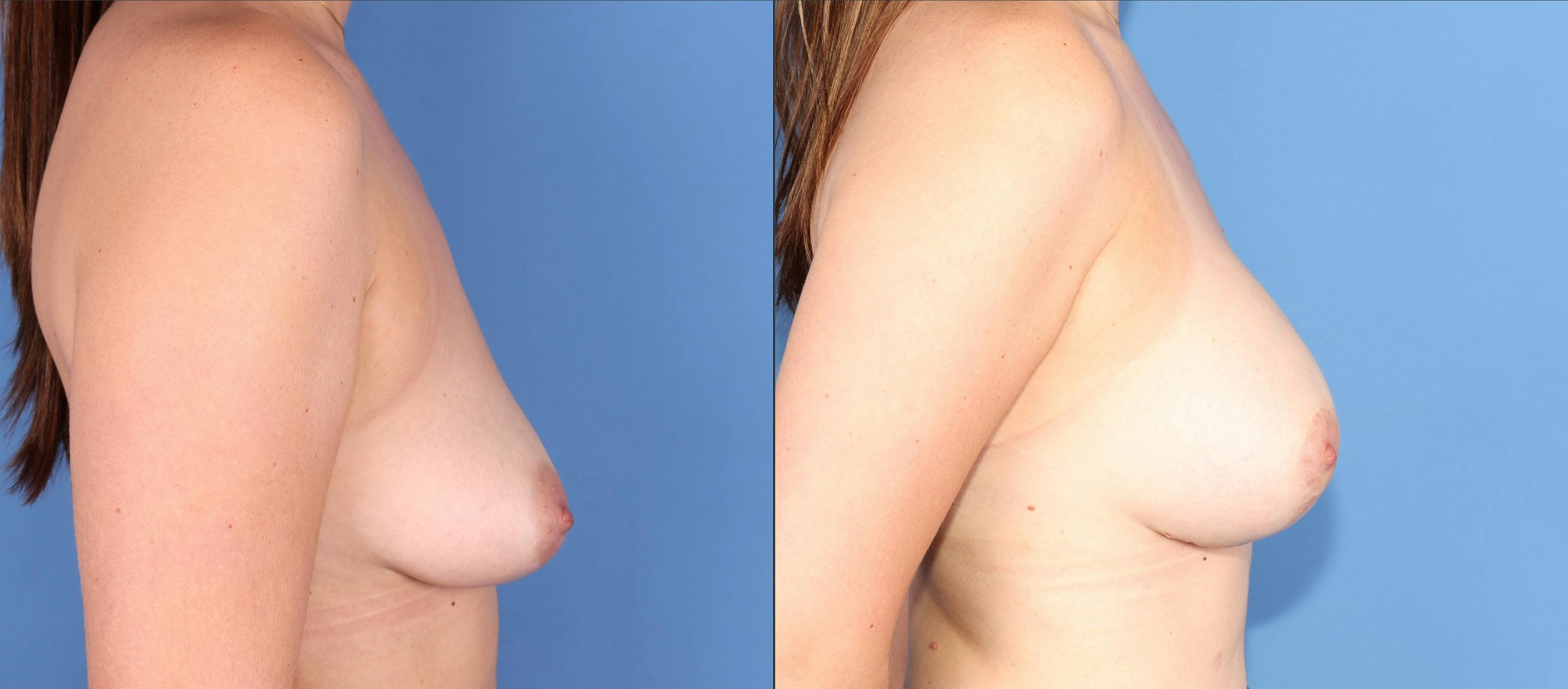 Breast Lift Before & After Gallery - Patient 354343 - Image 3