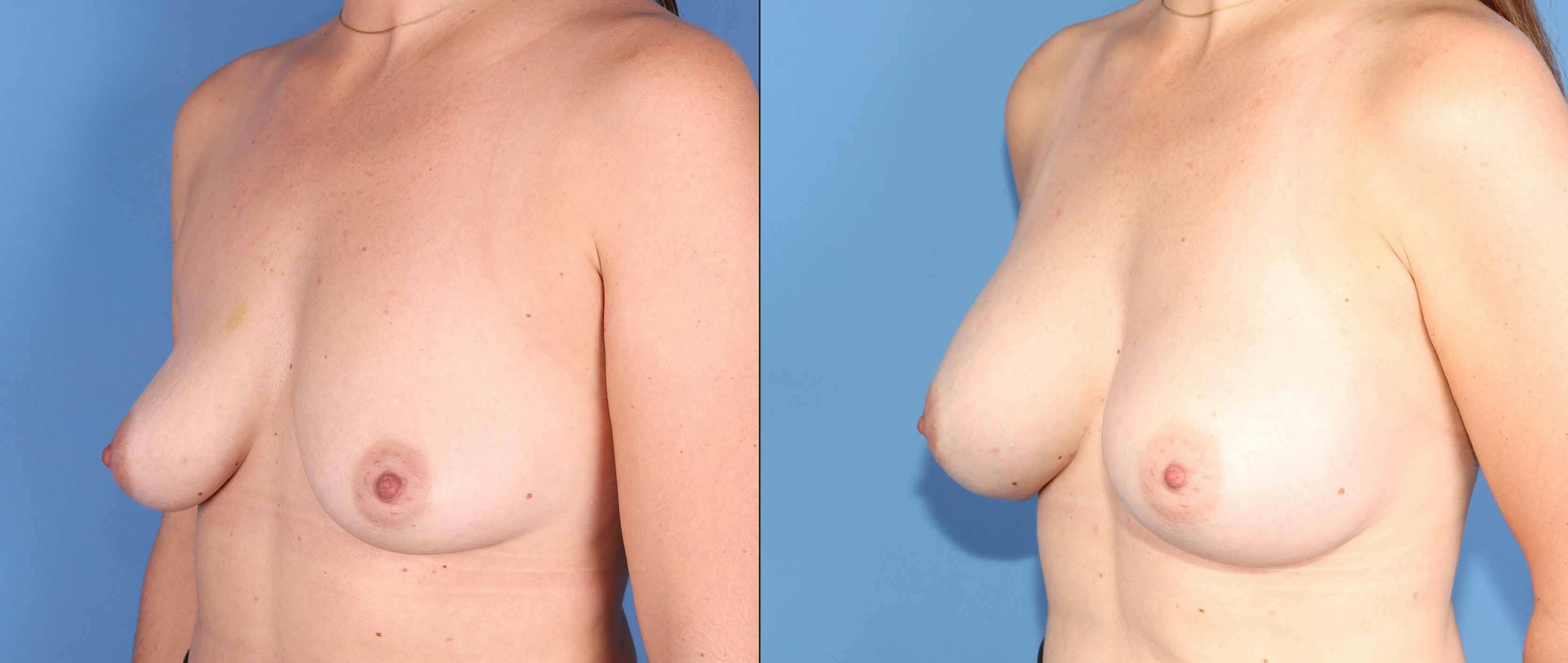 Breast Lift Before & After Gallery - Patient 354343 - Image 4