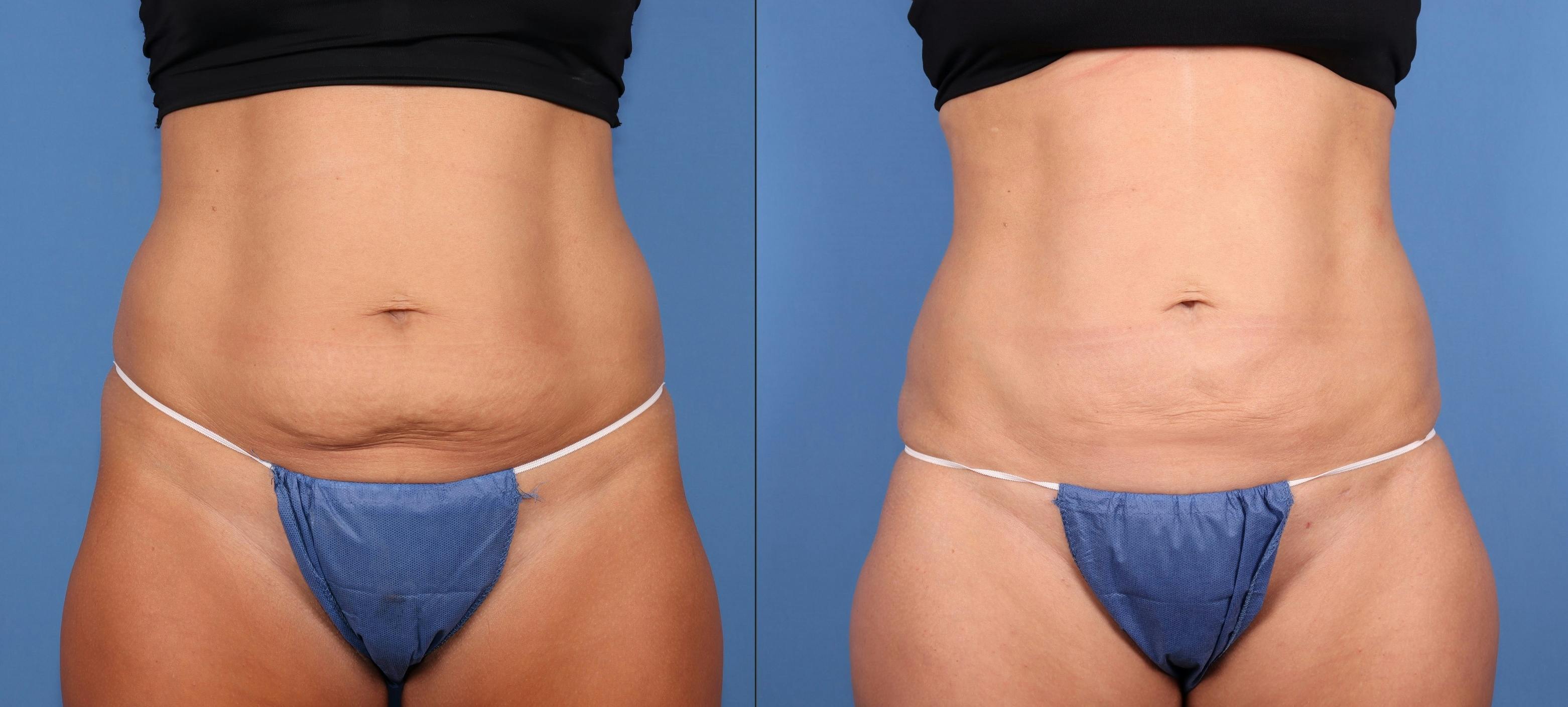 Abdomen Before & After Gallery - Patient 811517 - Image 1