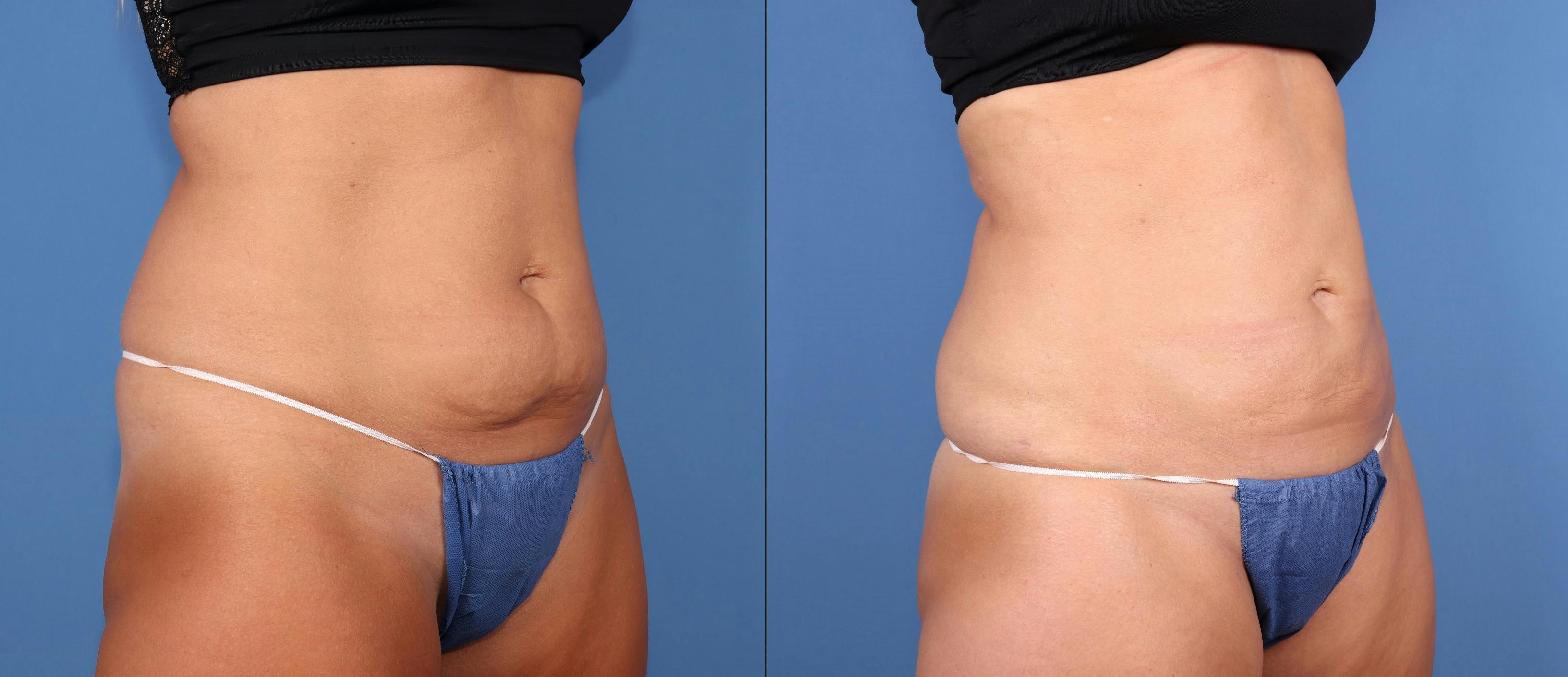 Abdomen Before & After Gallery - Patient 811517 - Image 2