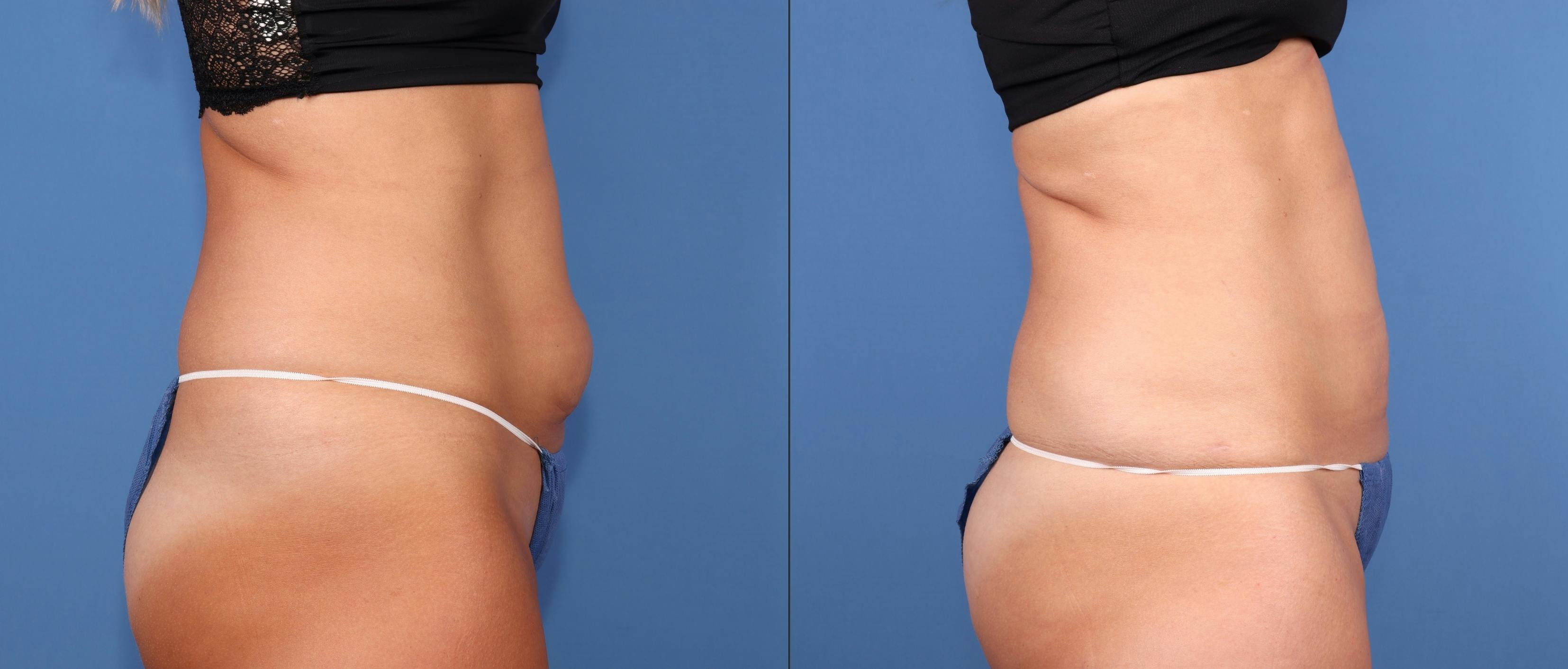 Abdomen Before & After Gallery - Patient 811517 - Image 3
