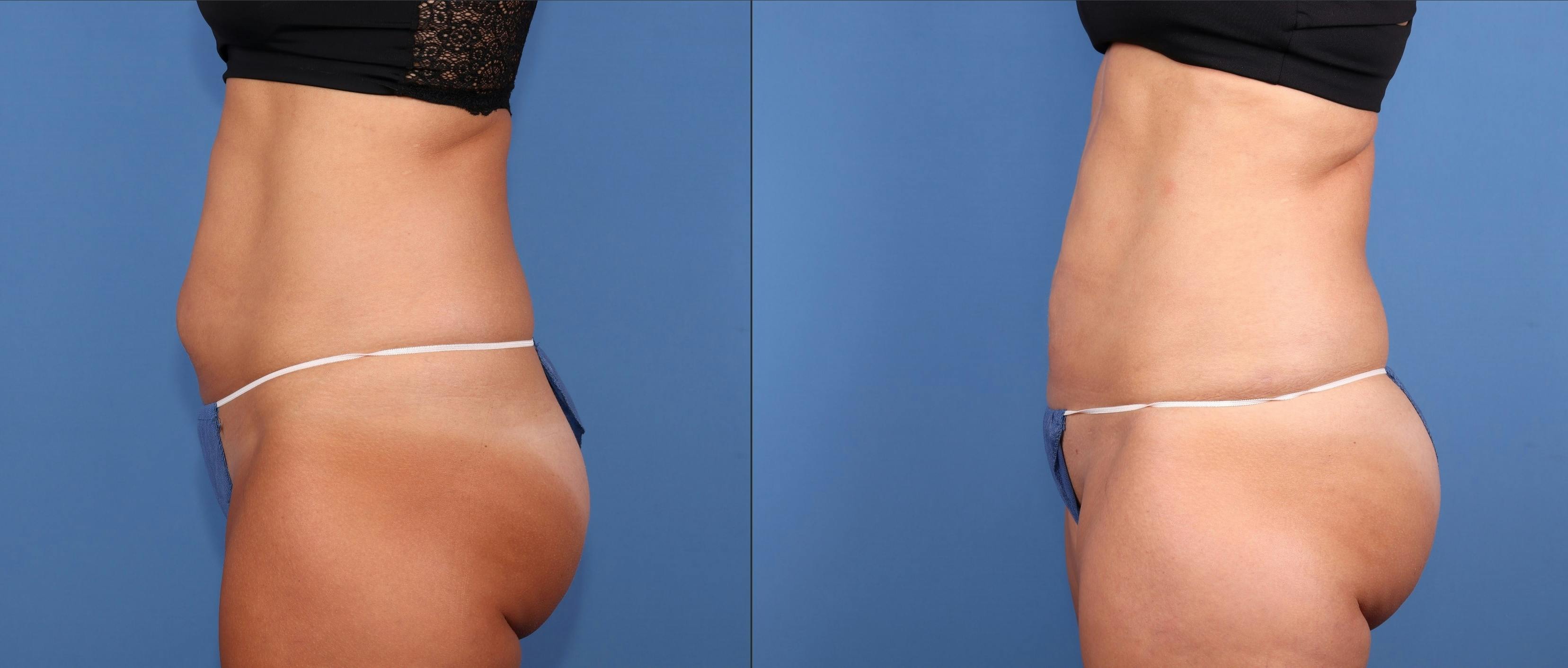 Abdomen Before & After Gallery - Patient 811517 - Image 5