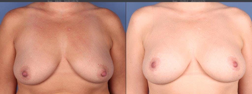 Breast Lift Before & After Gallery - Patient 944742 - Image 1