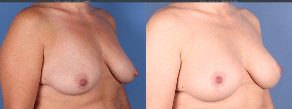 Breast Lift Before & After Gallery - Patient 944742 - Image 2