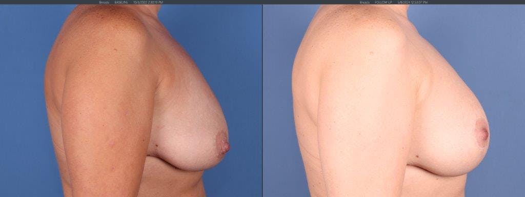 Breast Lift Before & After Gallery - Patient 944742 - Image 3
