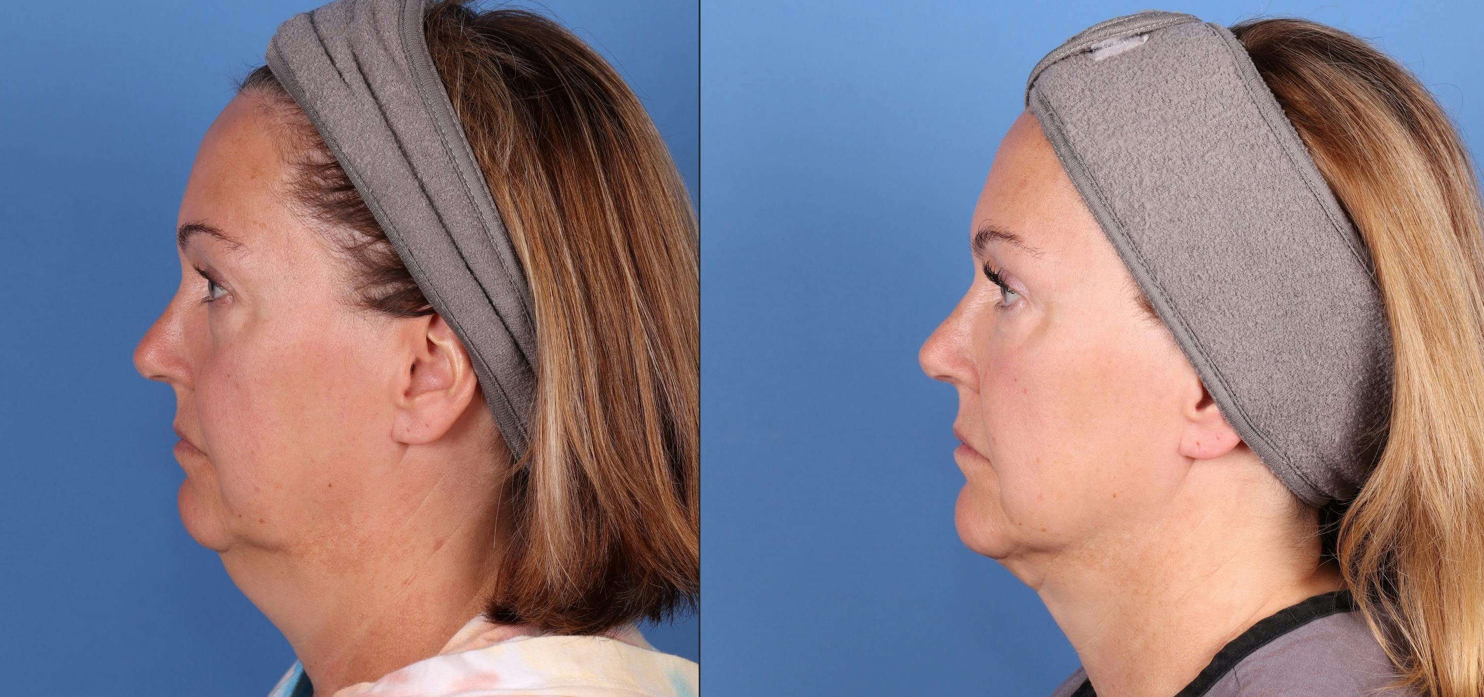 Face & Neck Before & After Gallery - Patient 230621 - Image 3