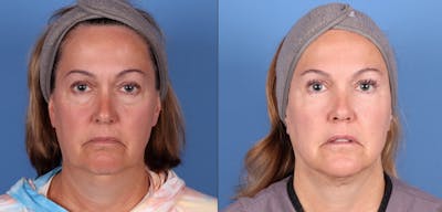 Eyelid Surgery (Upper & Lower Blepharoplasty) Before & After Gallery - Patient 160339 - Image 1