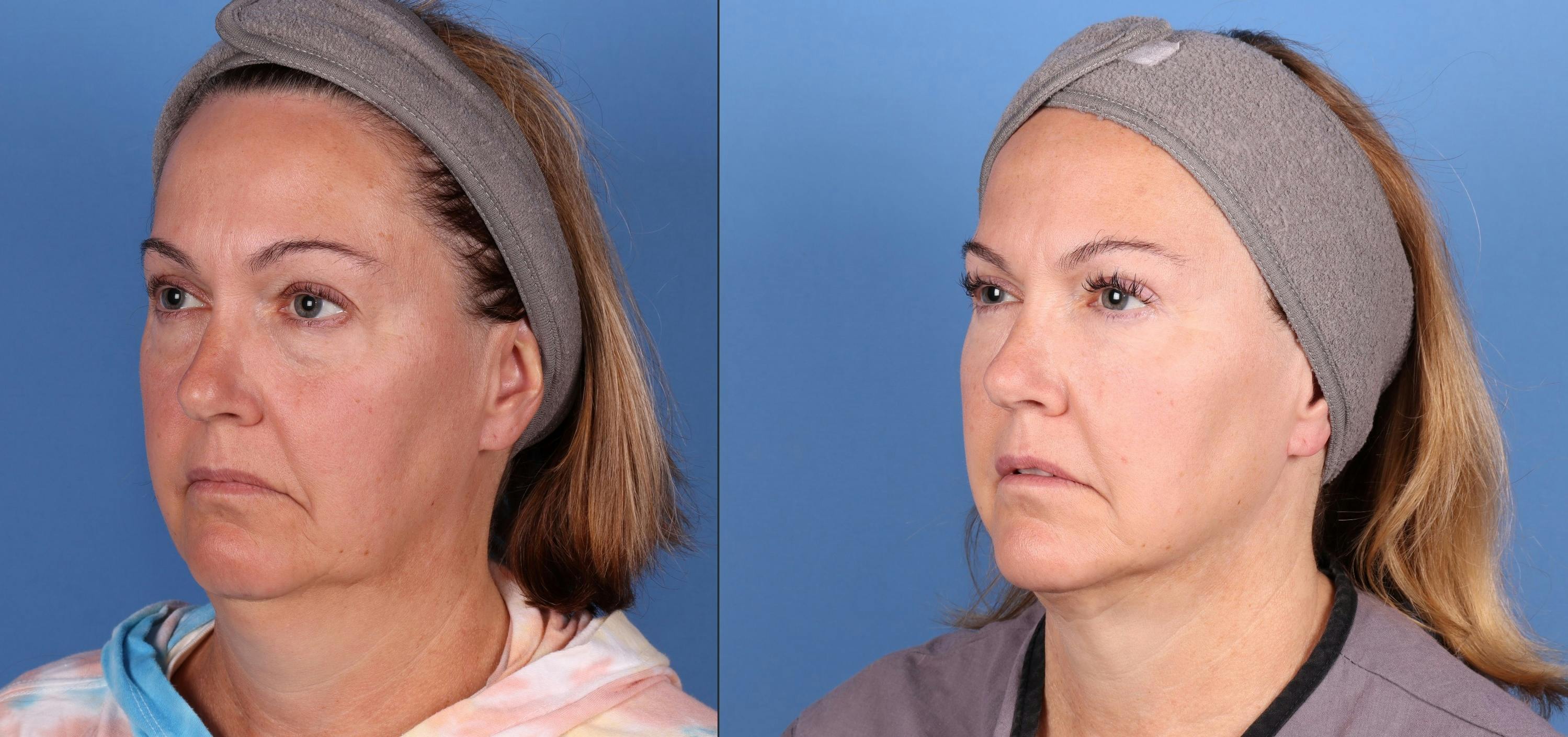 Face & Neck Before & After Gallery - Patient 230621 - Image 2