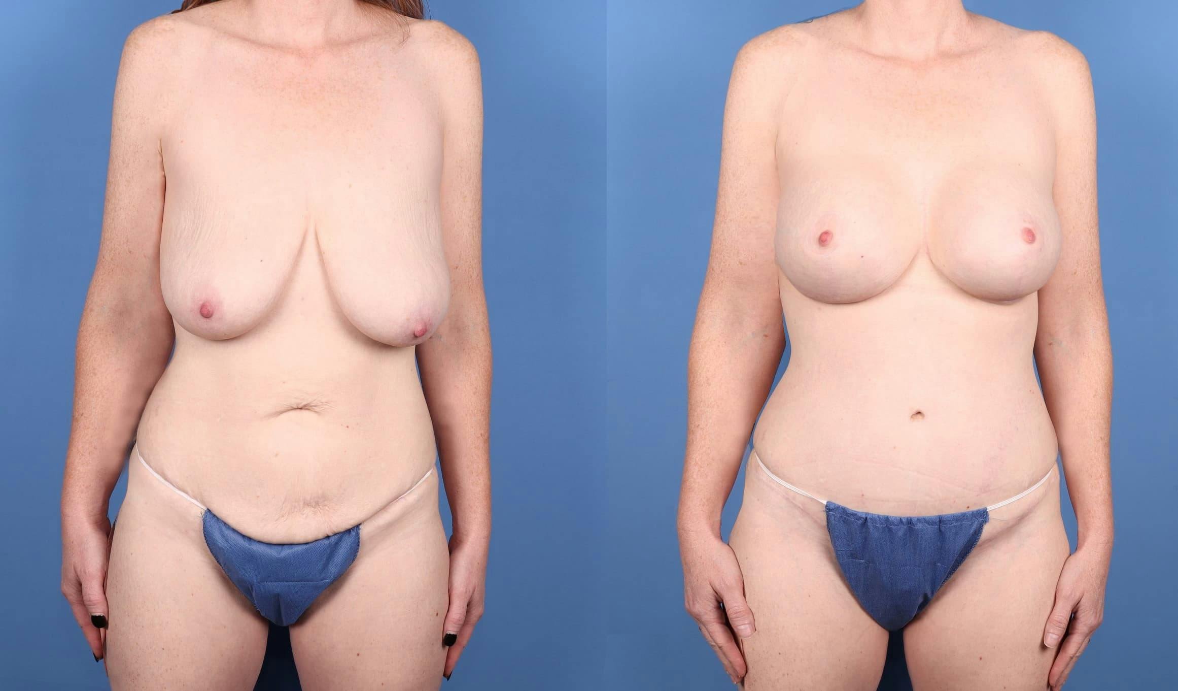 Mommy Makeover Before & After Gallery - Patient 177957 - Image 1