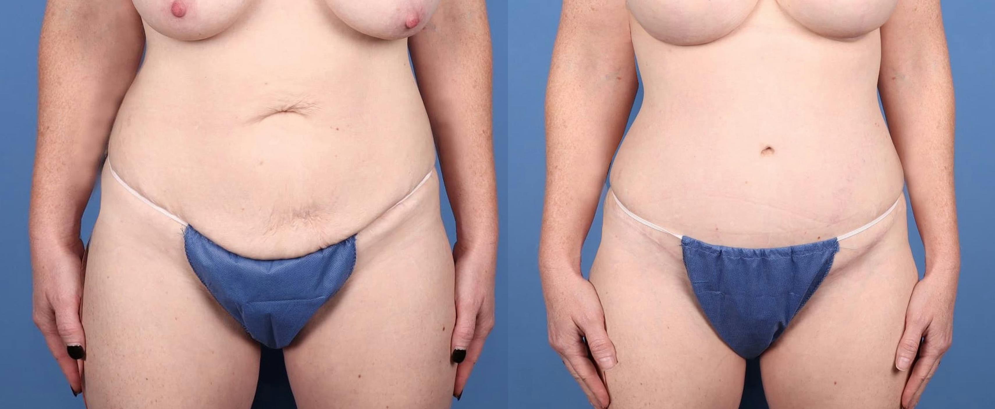 Tummy Tuck Before & After Gallery - Patient 199489 - Image 1