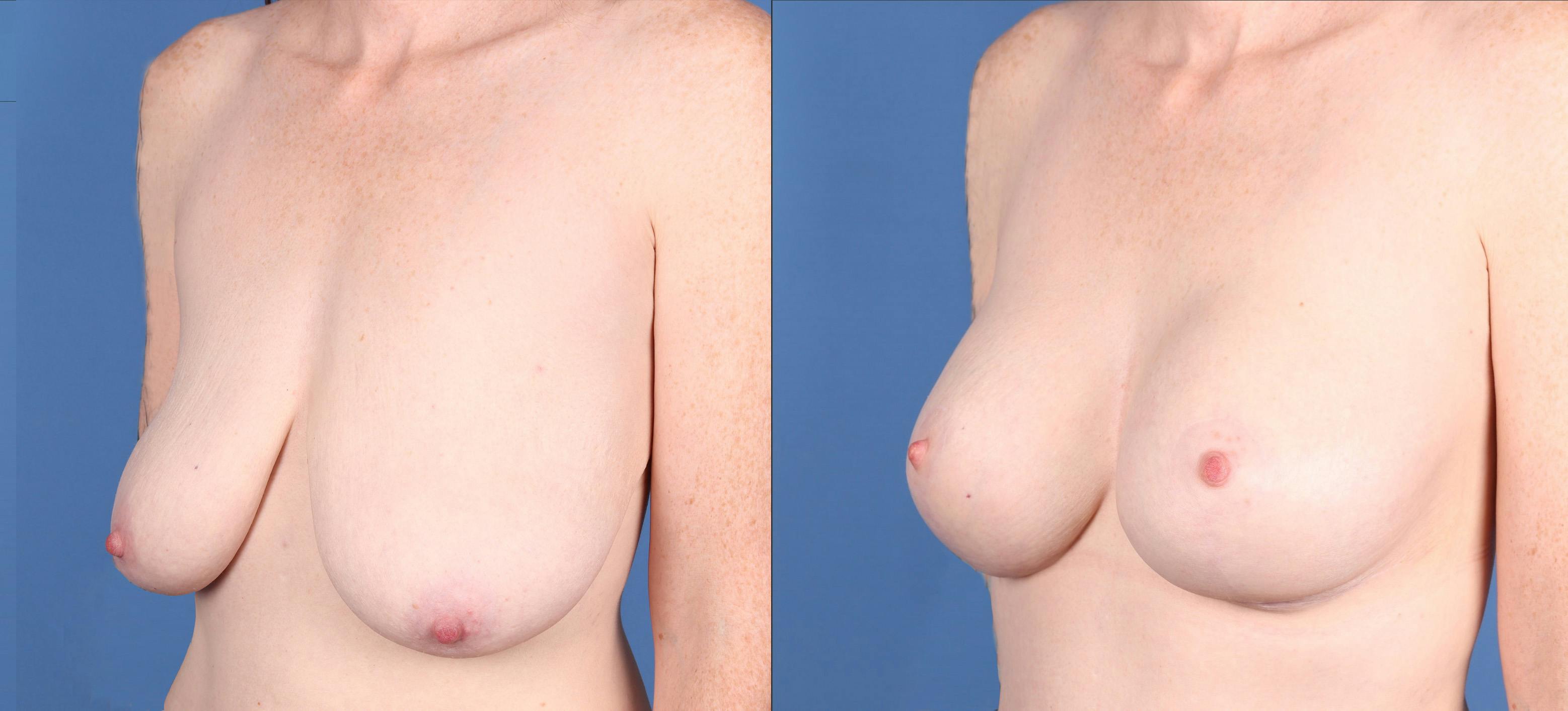 Breast Lift with Augmentation Before & After Gallery - Patient 425261 - Image 3