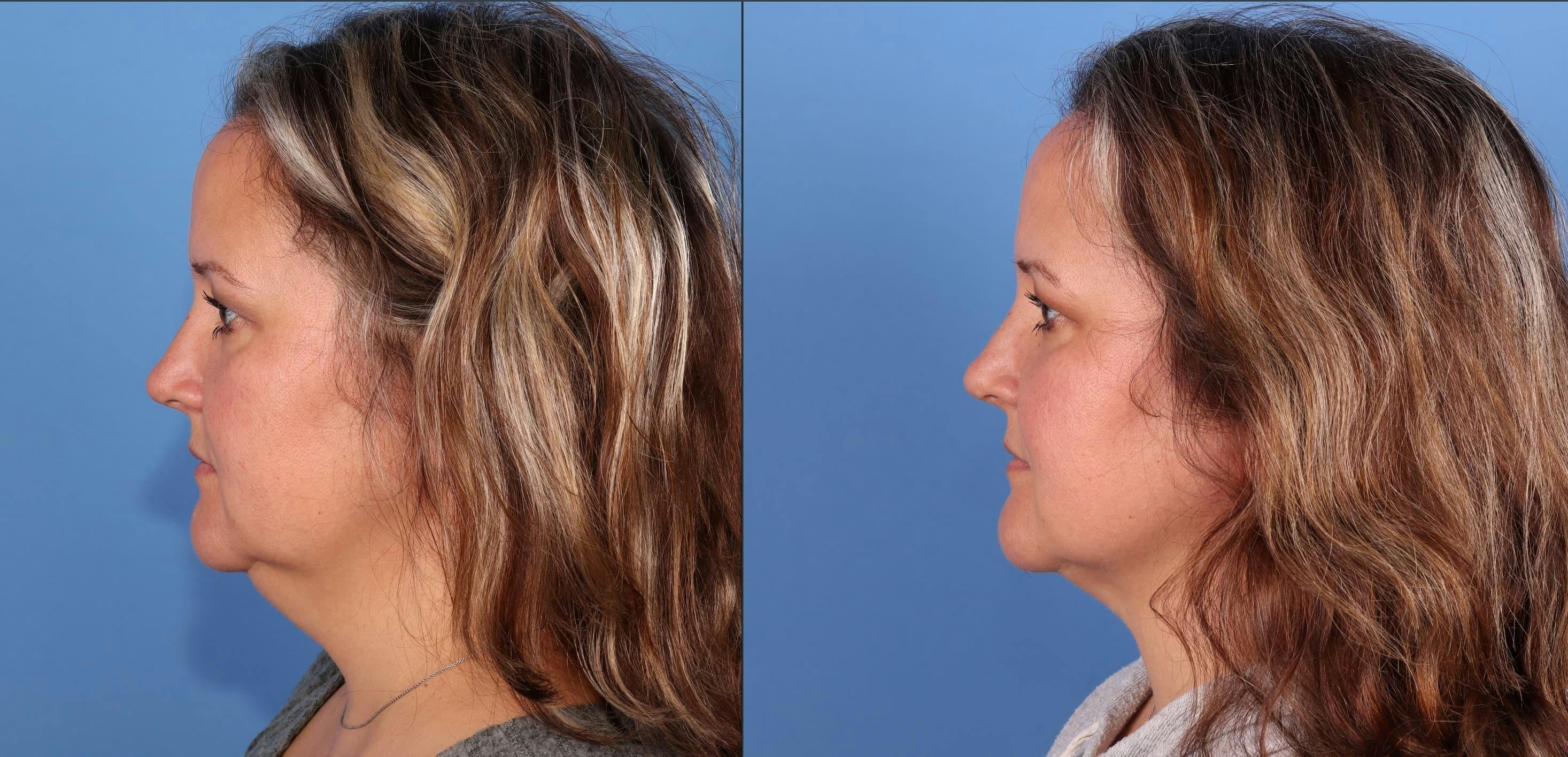 Face & Neck Before & After Gallery - Patient 399676 - Image 3