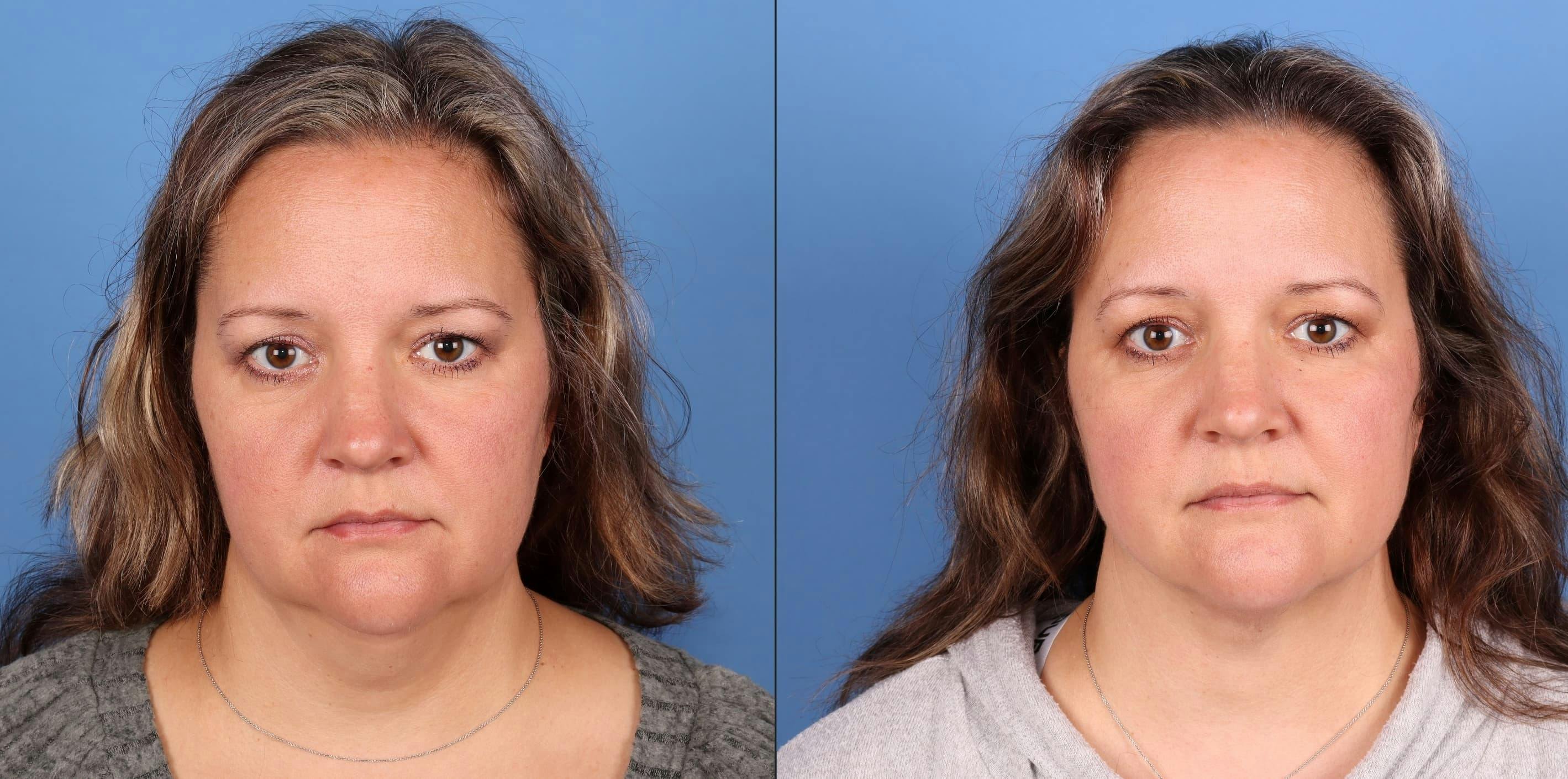 Face & Neck Before & After Gallery - Patient 399676 - Image 1